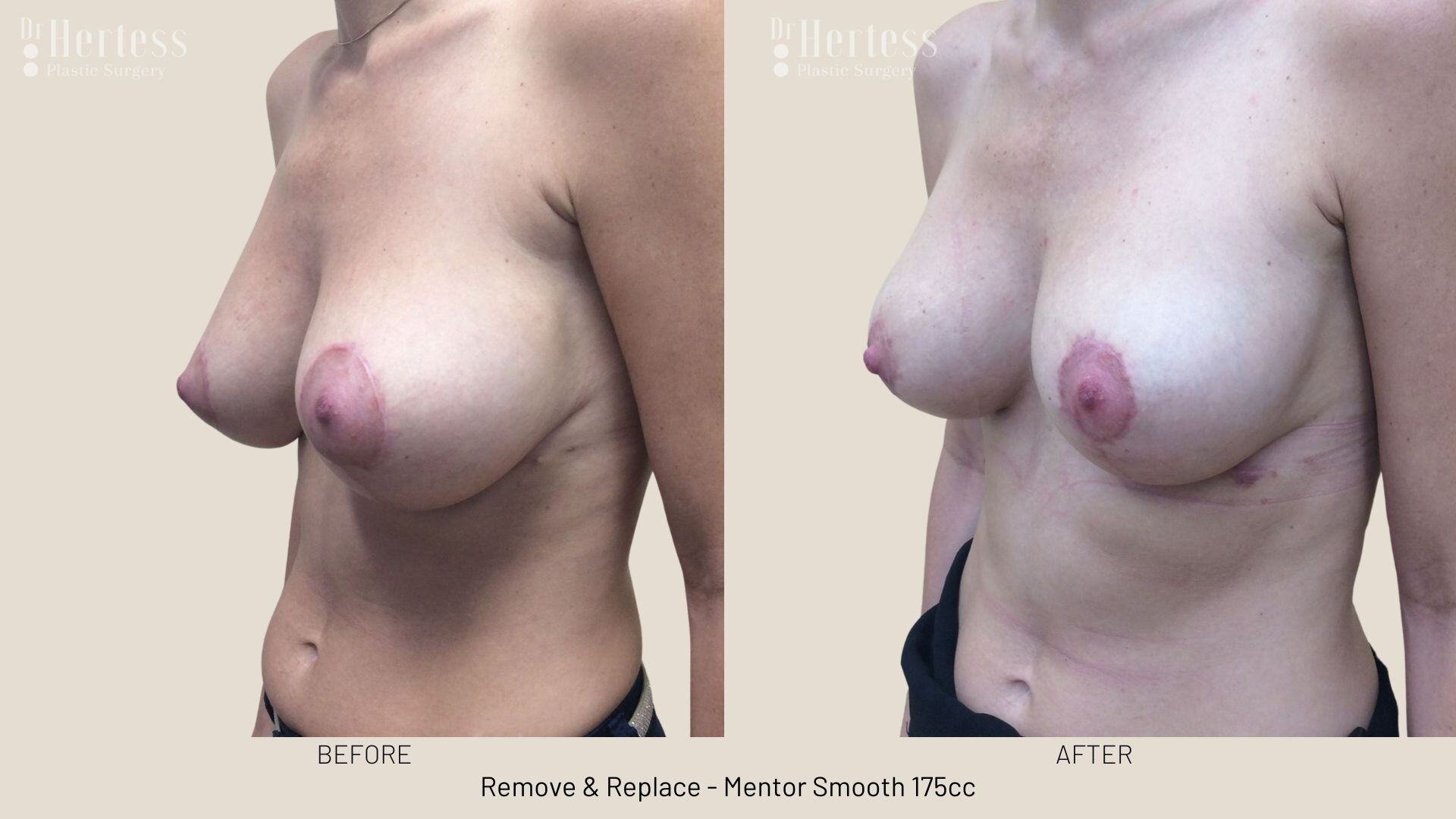 remove replace implants photos