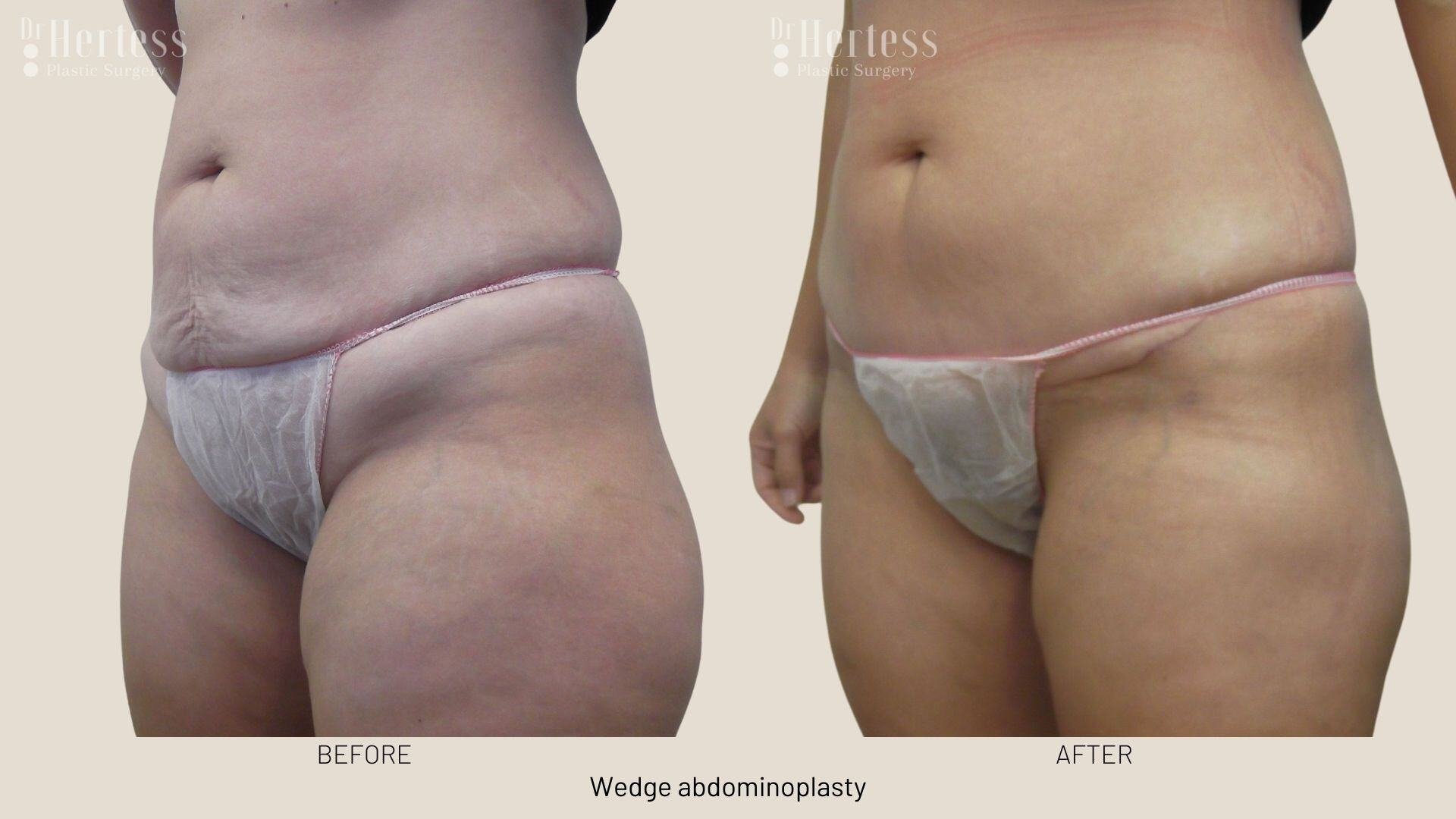 tummy tuck before and after