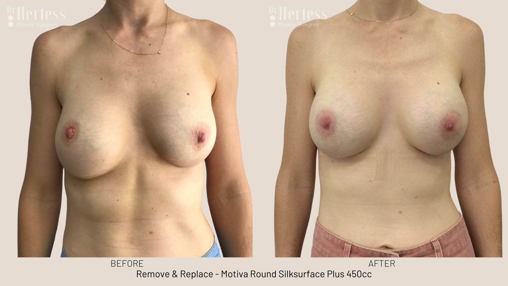 remove replace implants photos