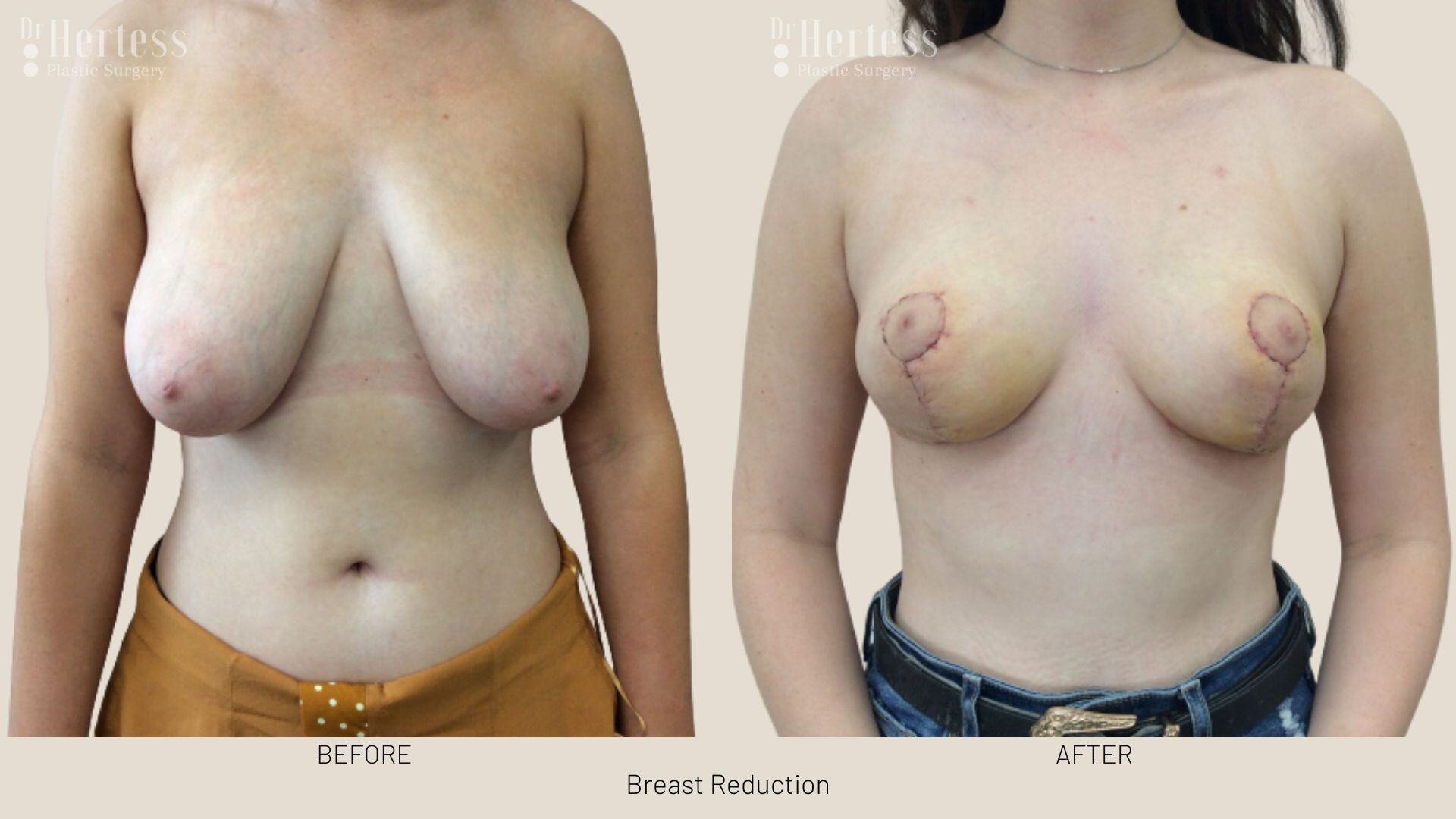 breast reduction before and after