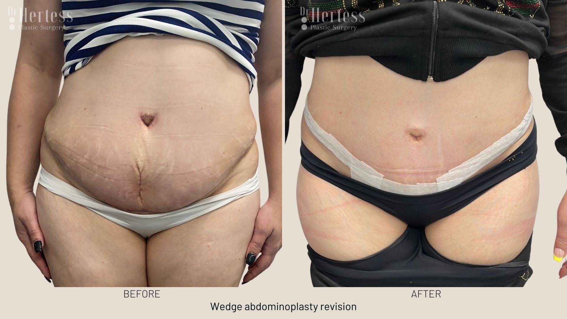 tummy tuck before and after