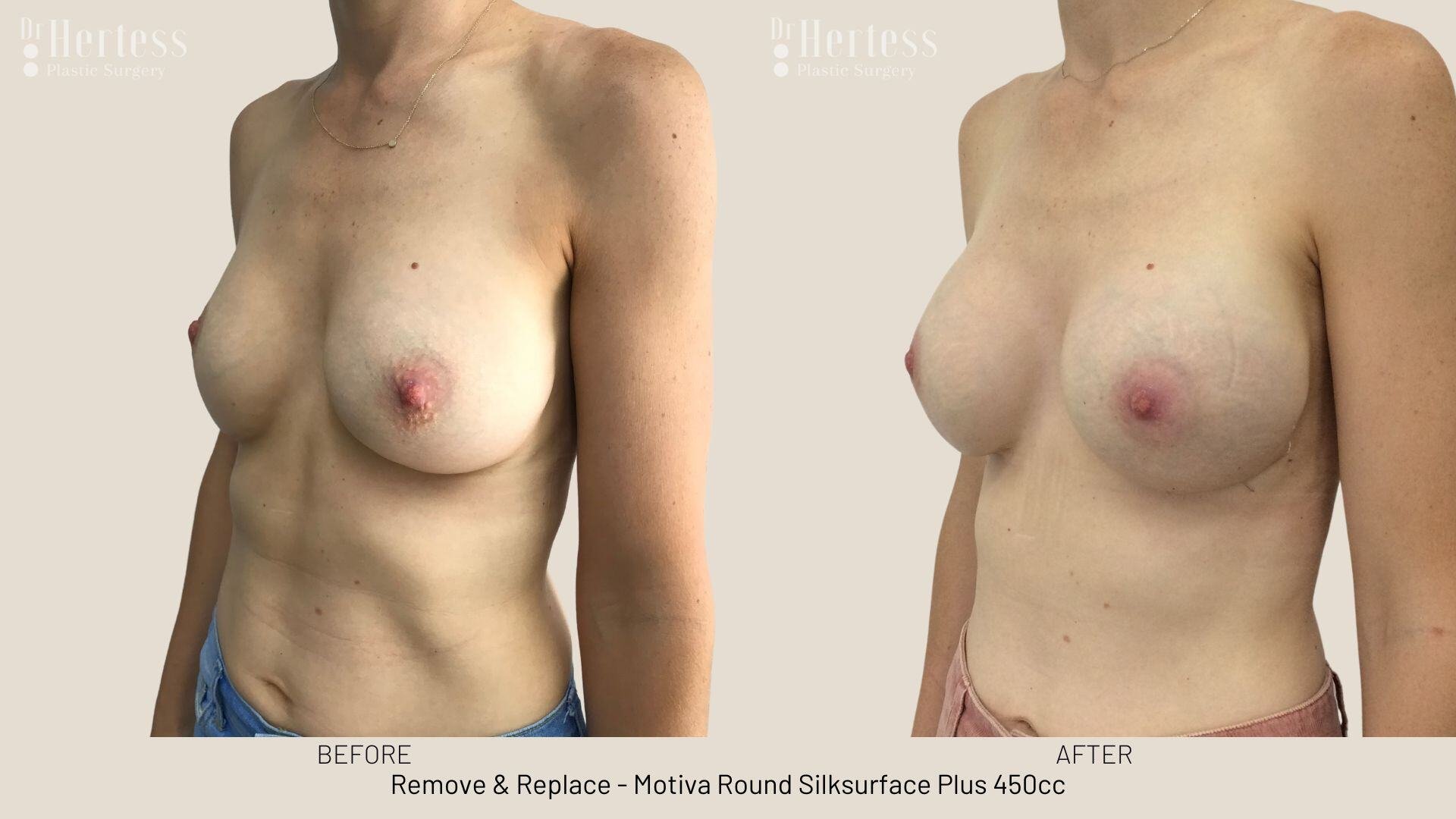 remove replace implants photos