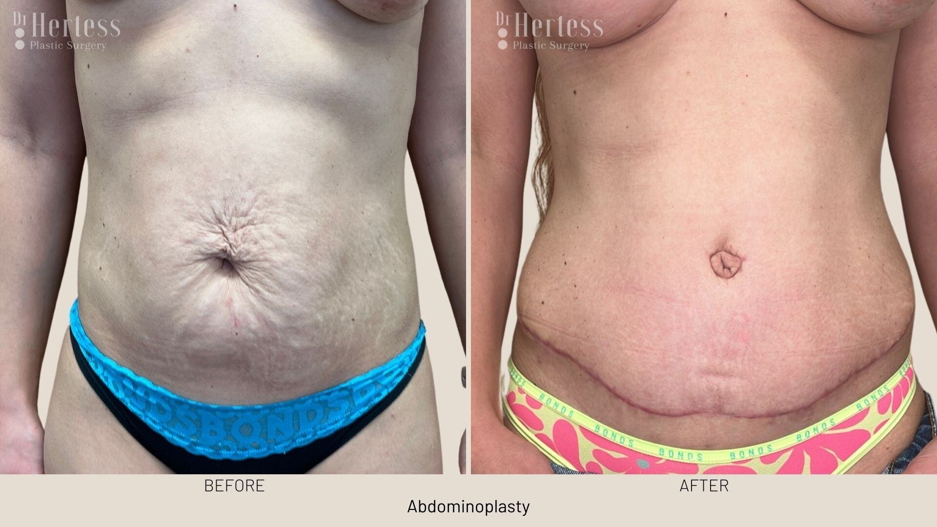 tummy tuck before and after
