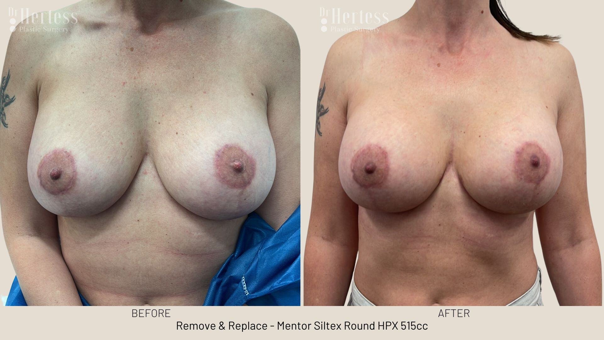 remove replace implants photos