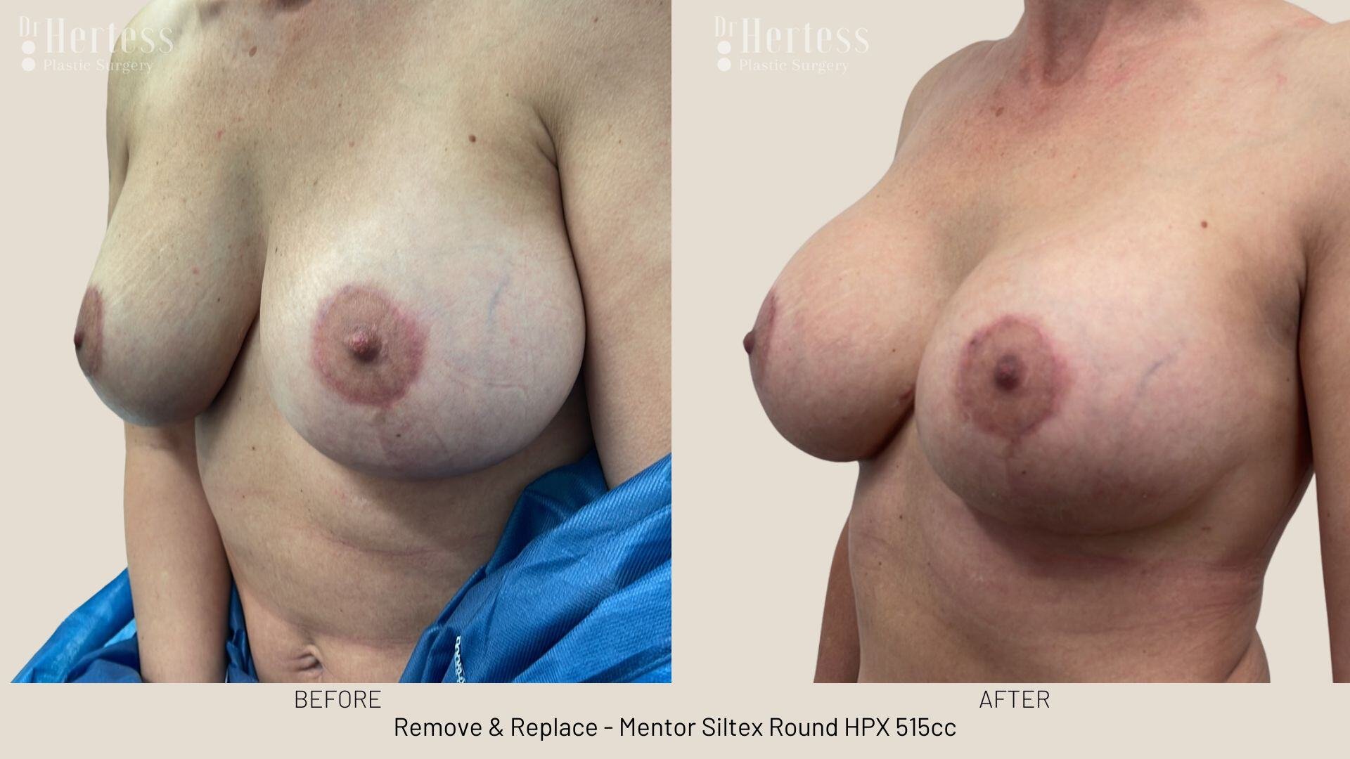 remove replace implants photos