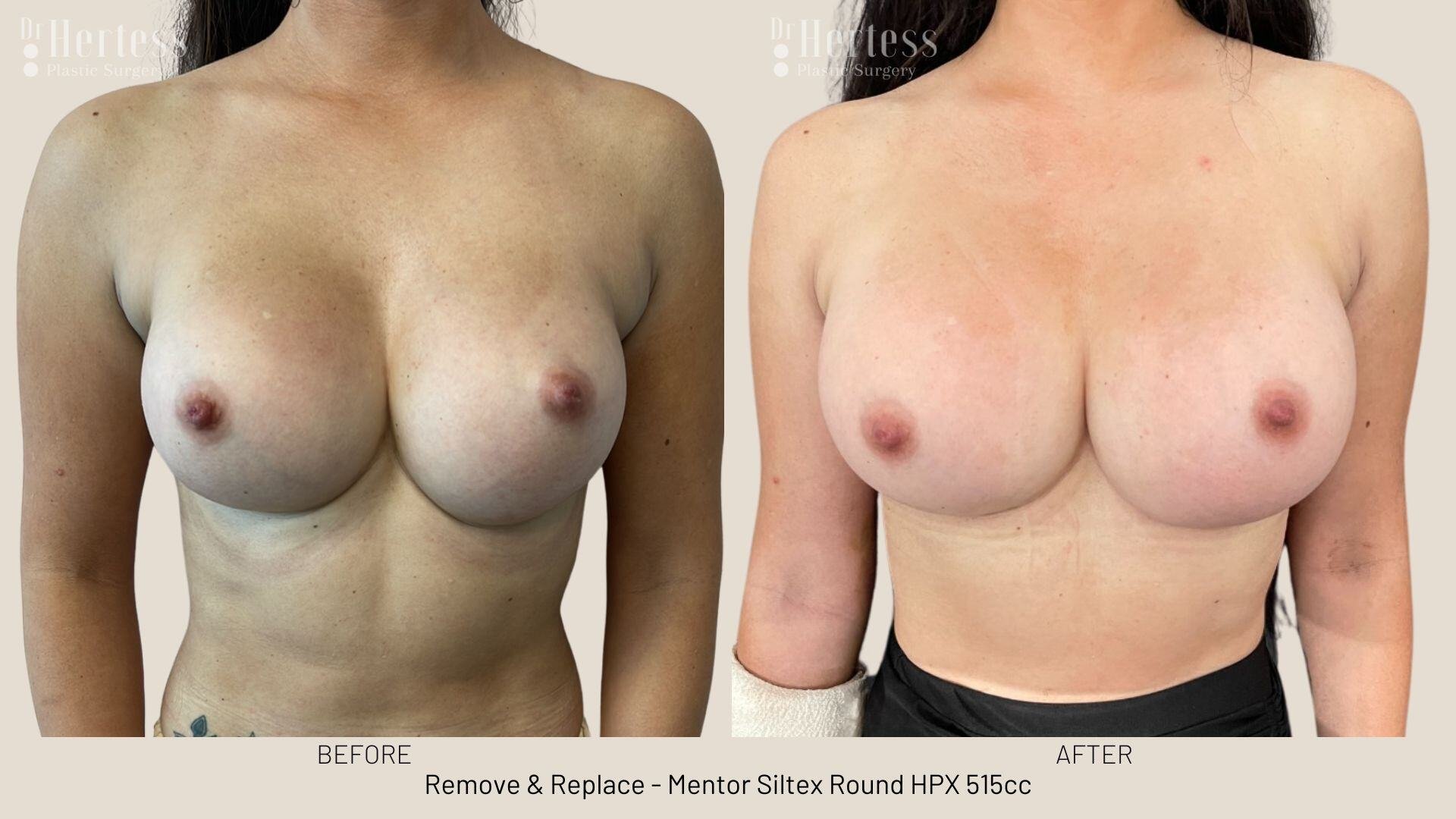 remove replace implants photos