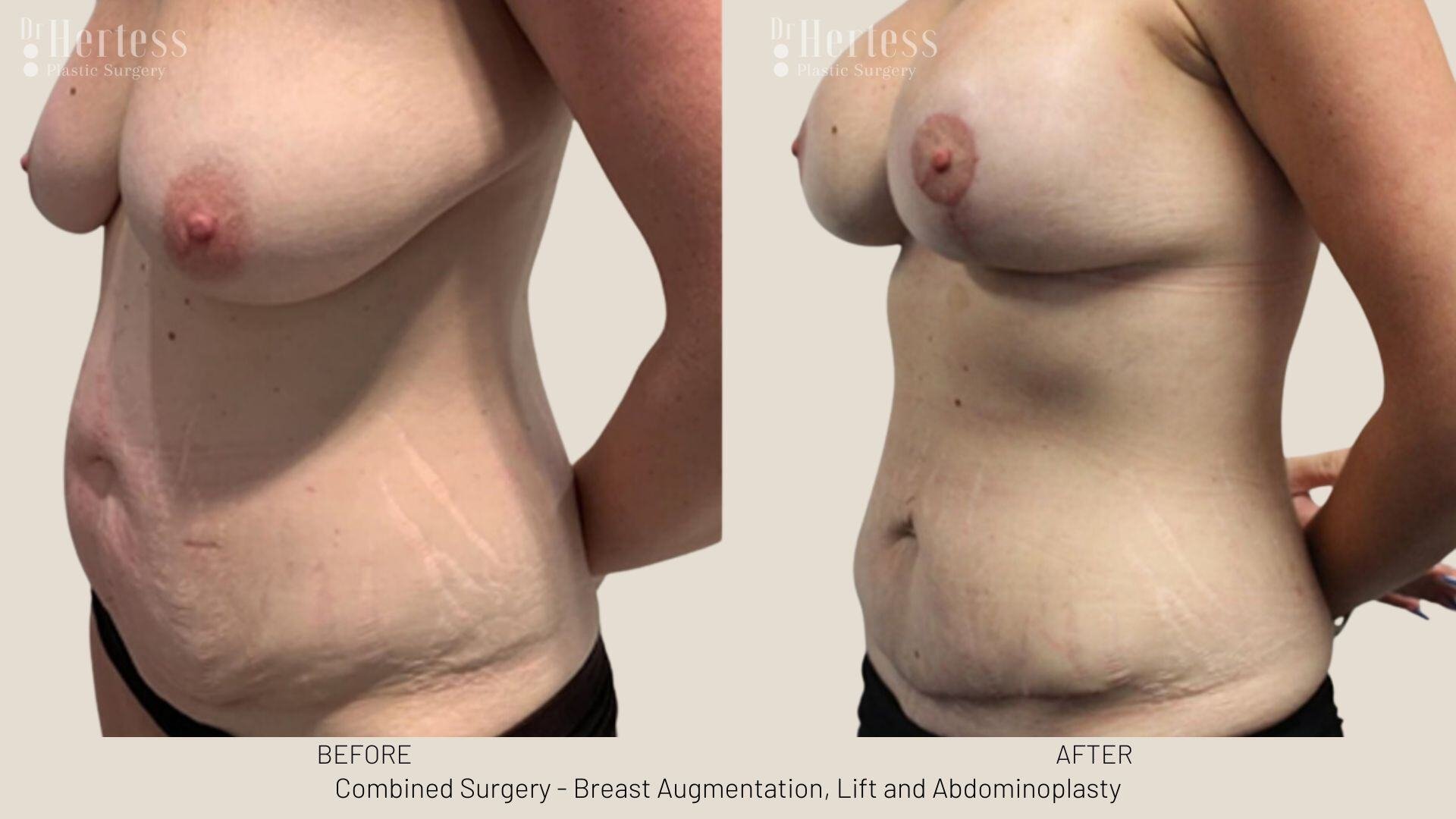 mummy makeover before and after photos