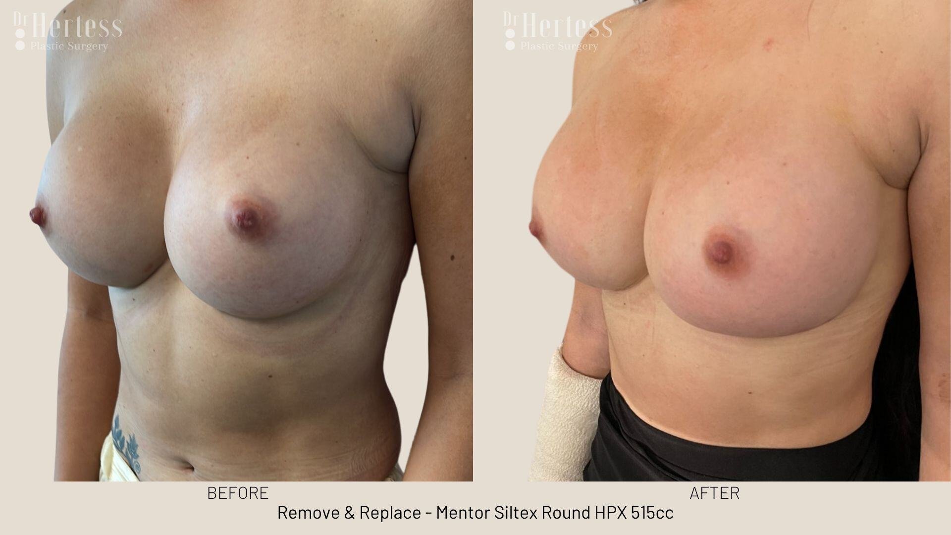 remove replace implants photos