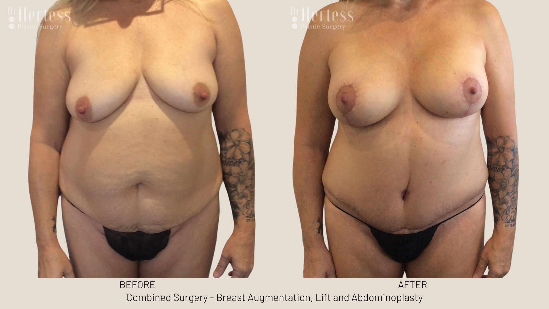 mummy makeover before and after photos