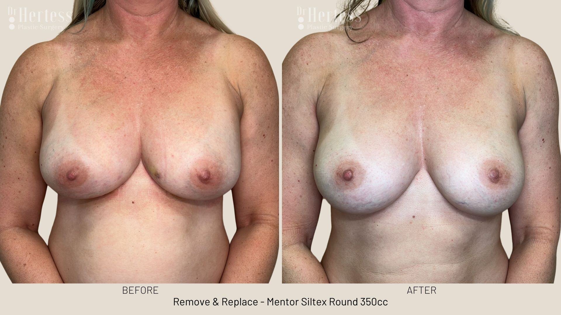 remove replace implants photos