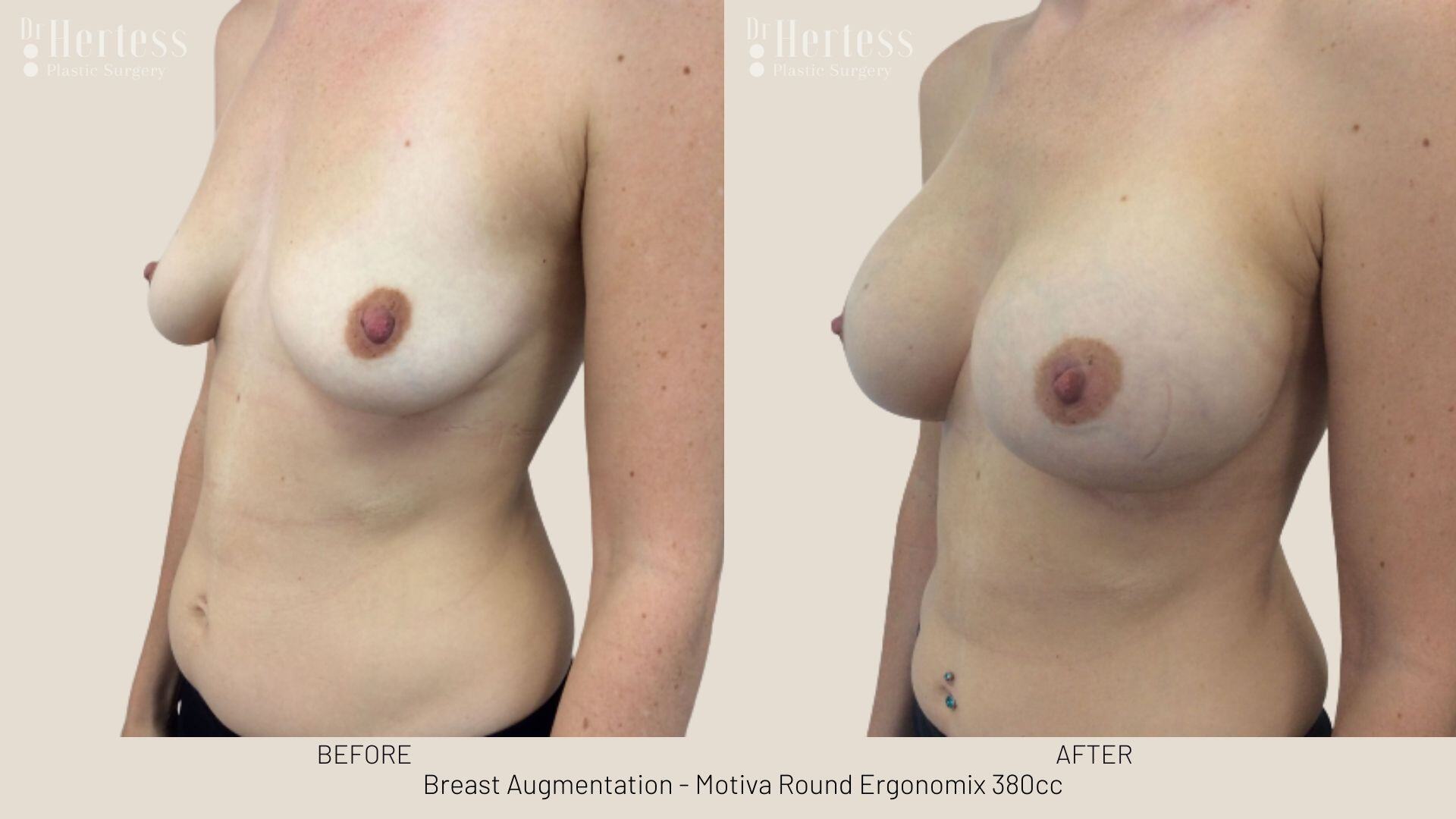 breast implant photos before and after