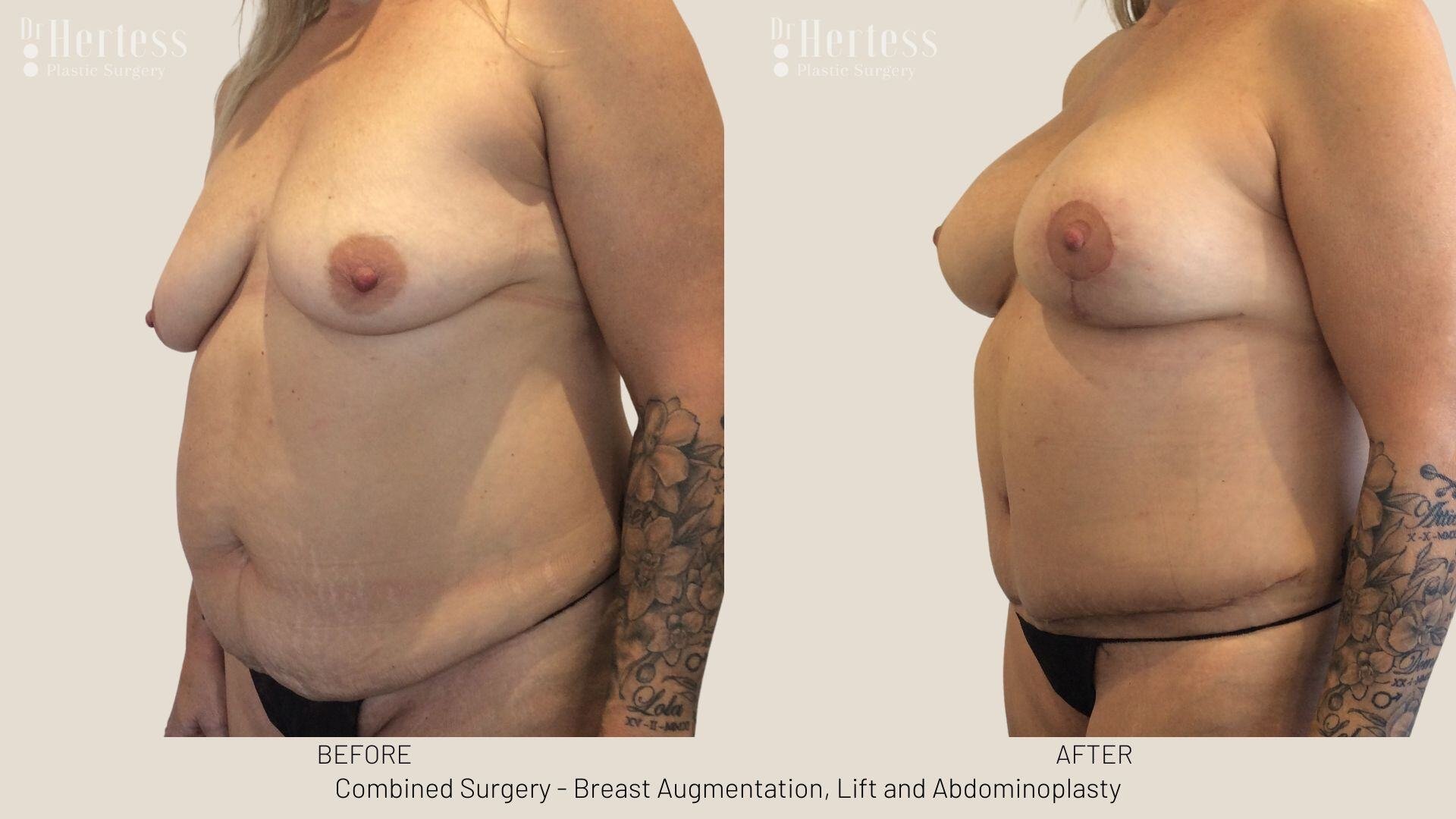mummy makeover before and after photos