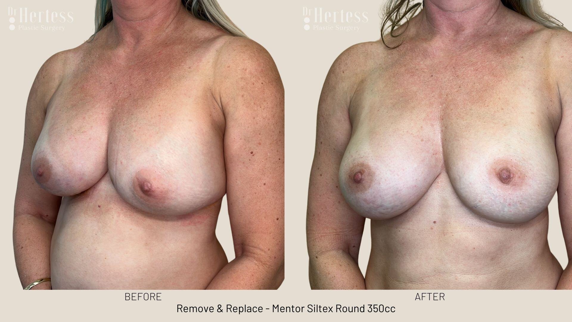 remove replace implants photos