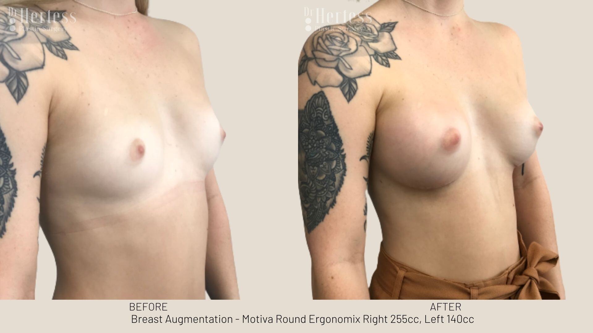 boob job photos before and after