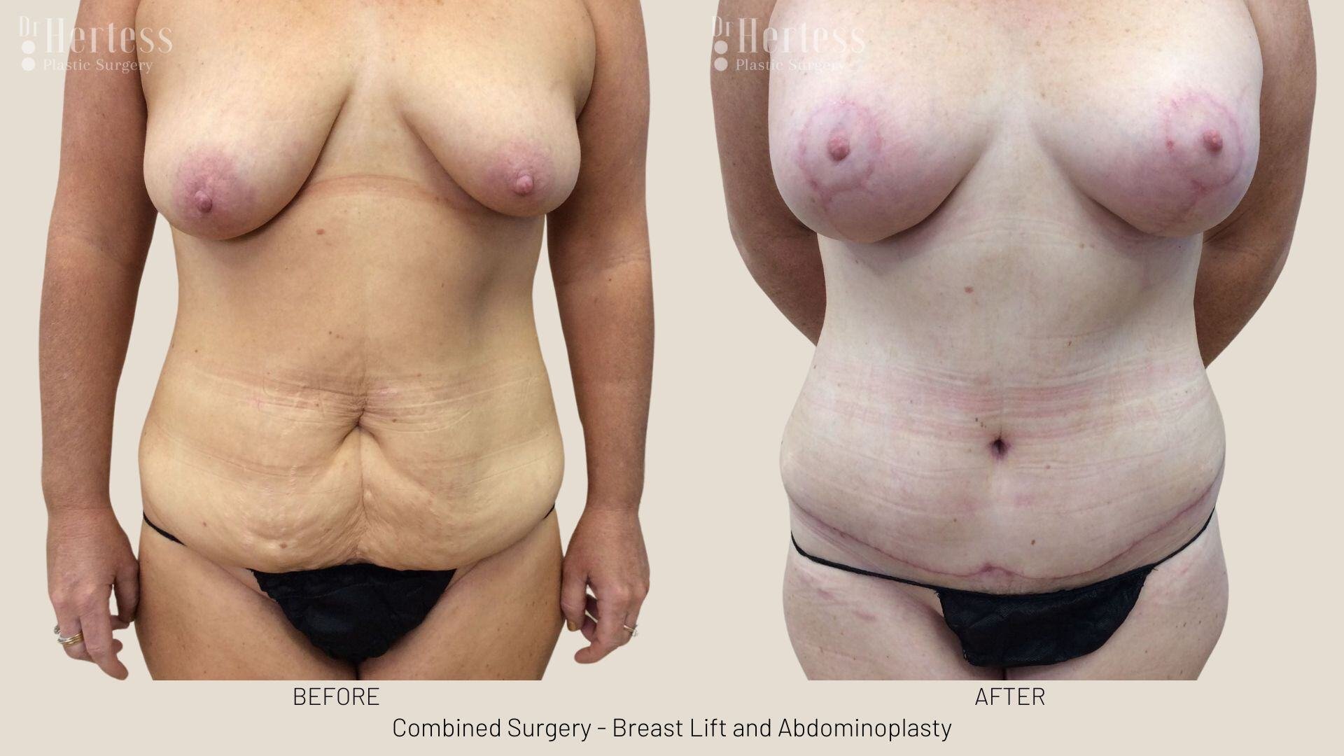 mummy makeover before and after photos