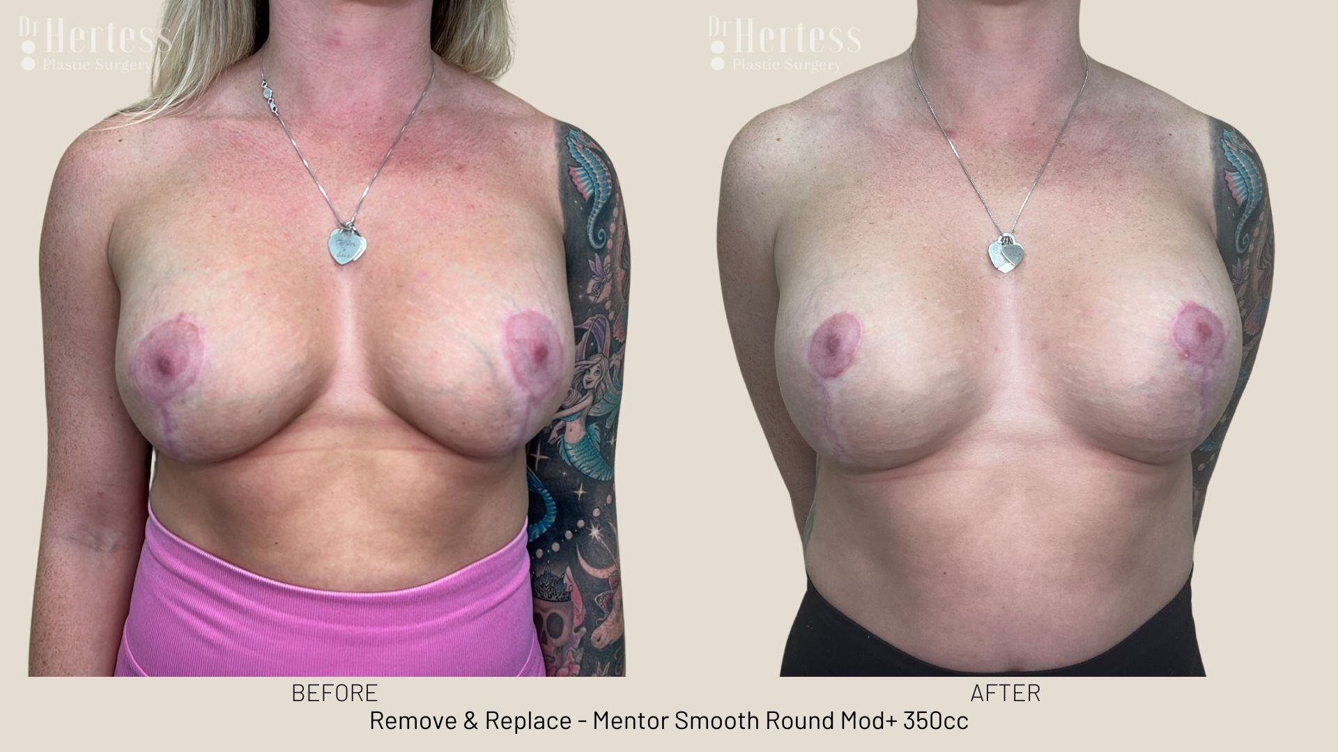remove replace implants photos