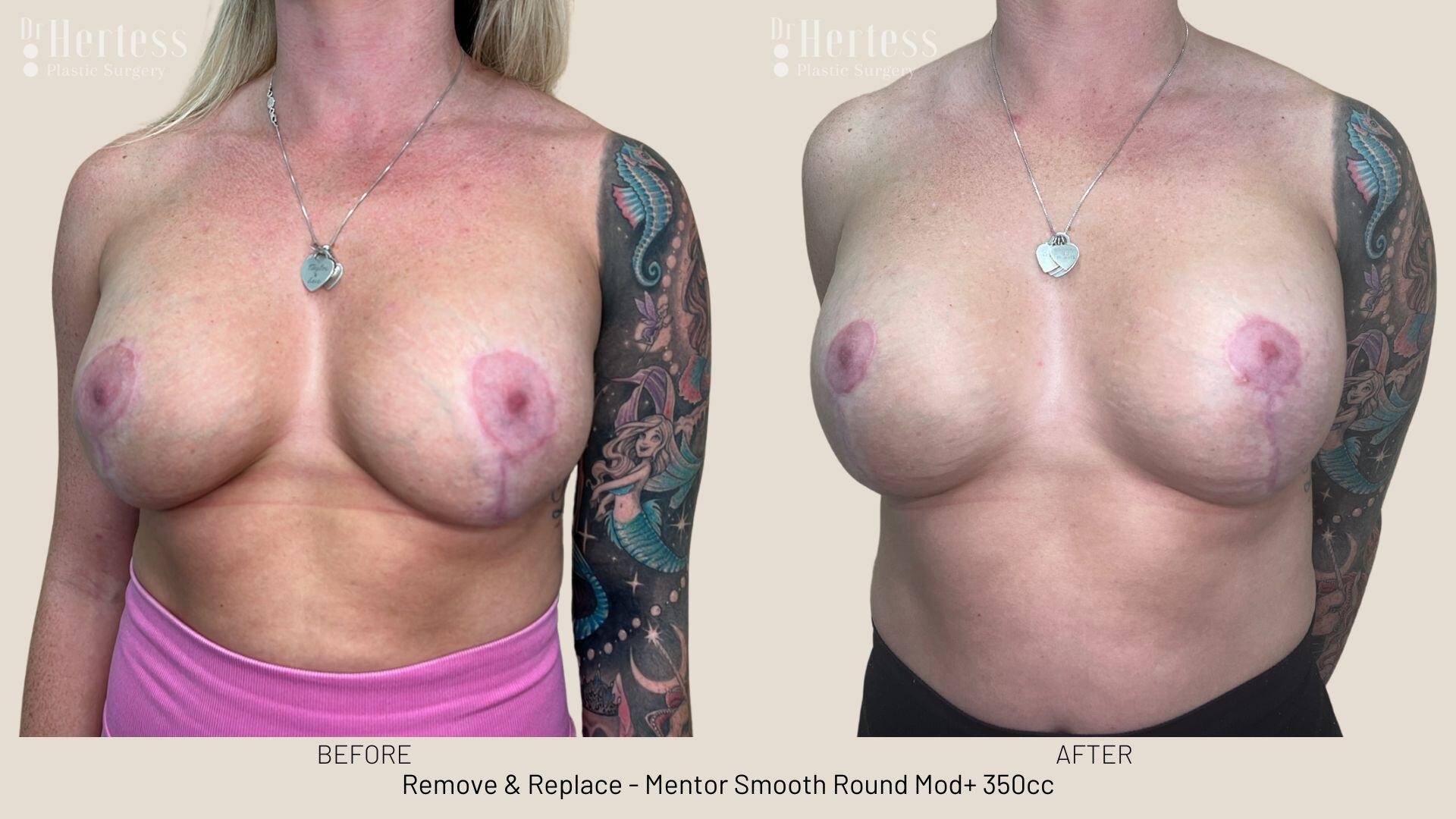 remove replace implants photos