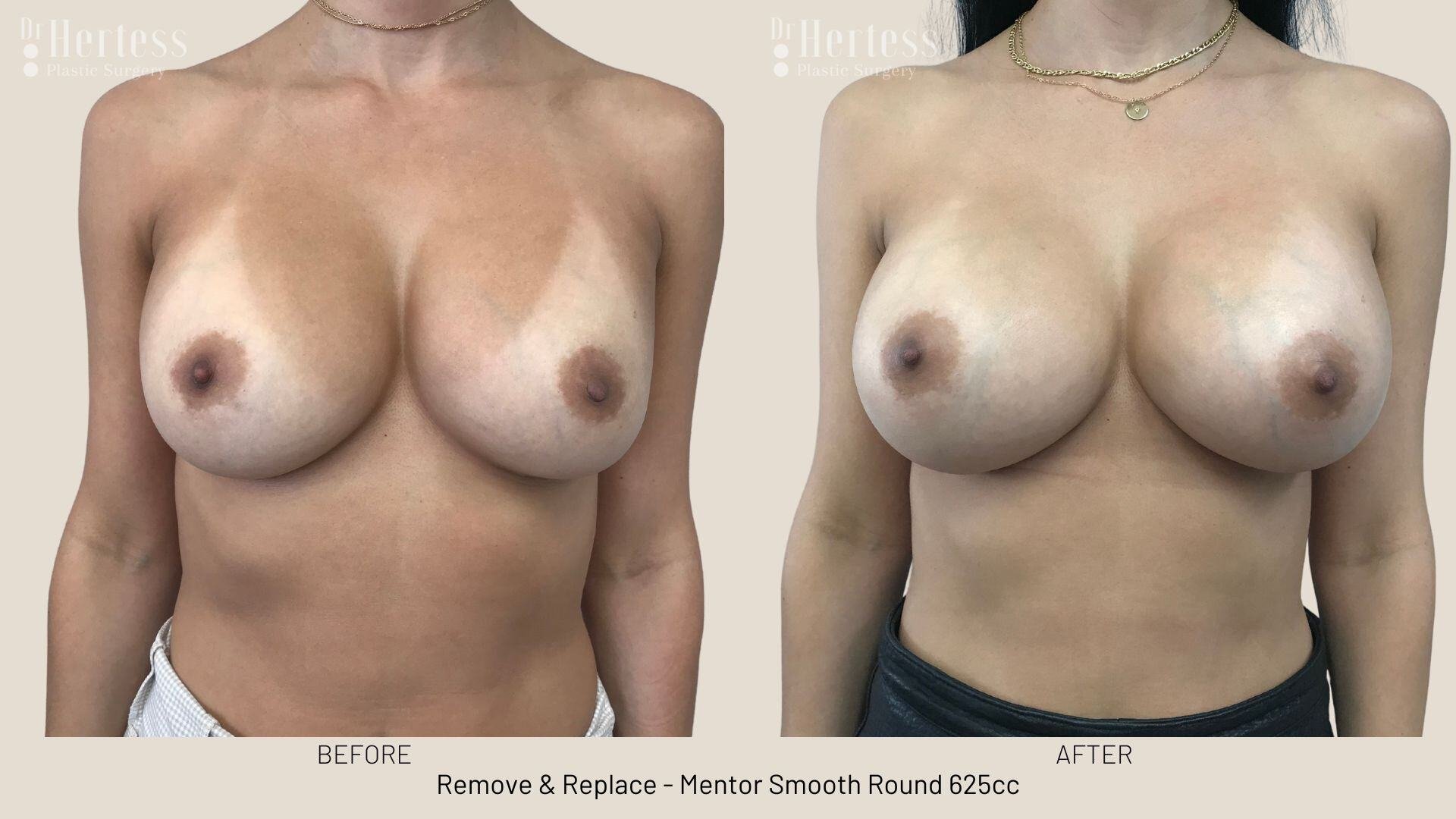 remove replace implants photos
