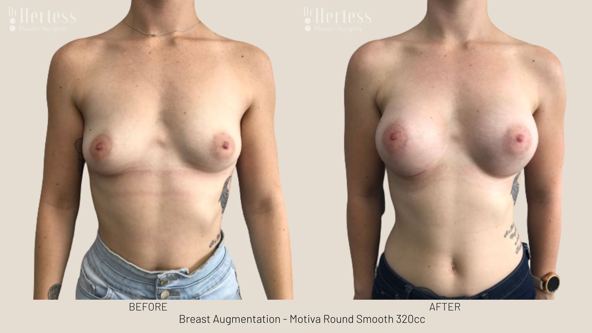 boob job photos before and after