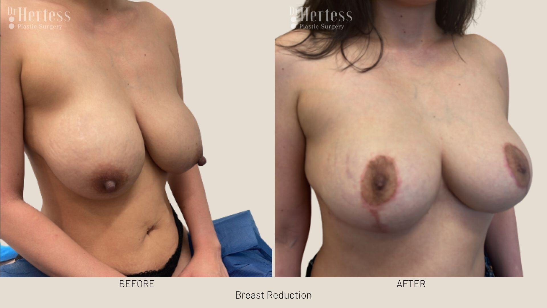 breast reduction before and after