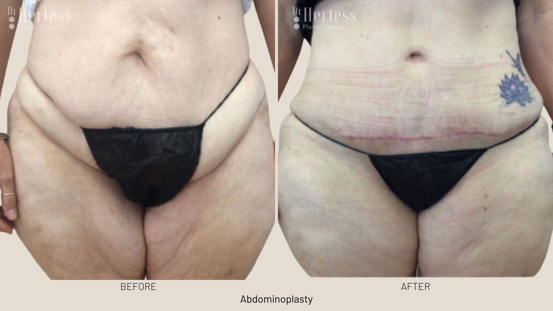 abdominoplasty before and after photos