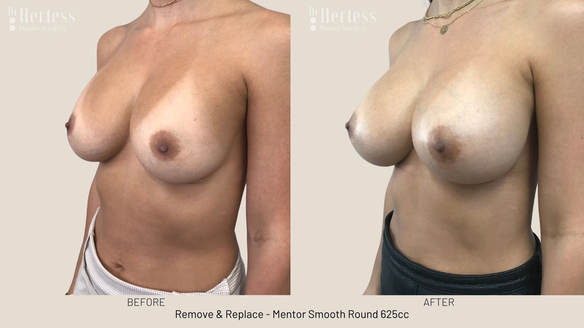 remove replace implants photos