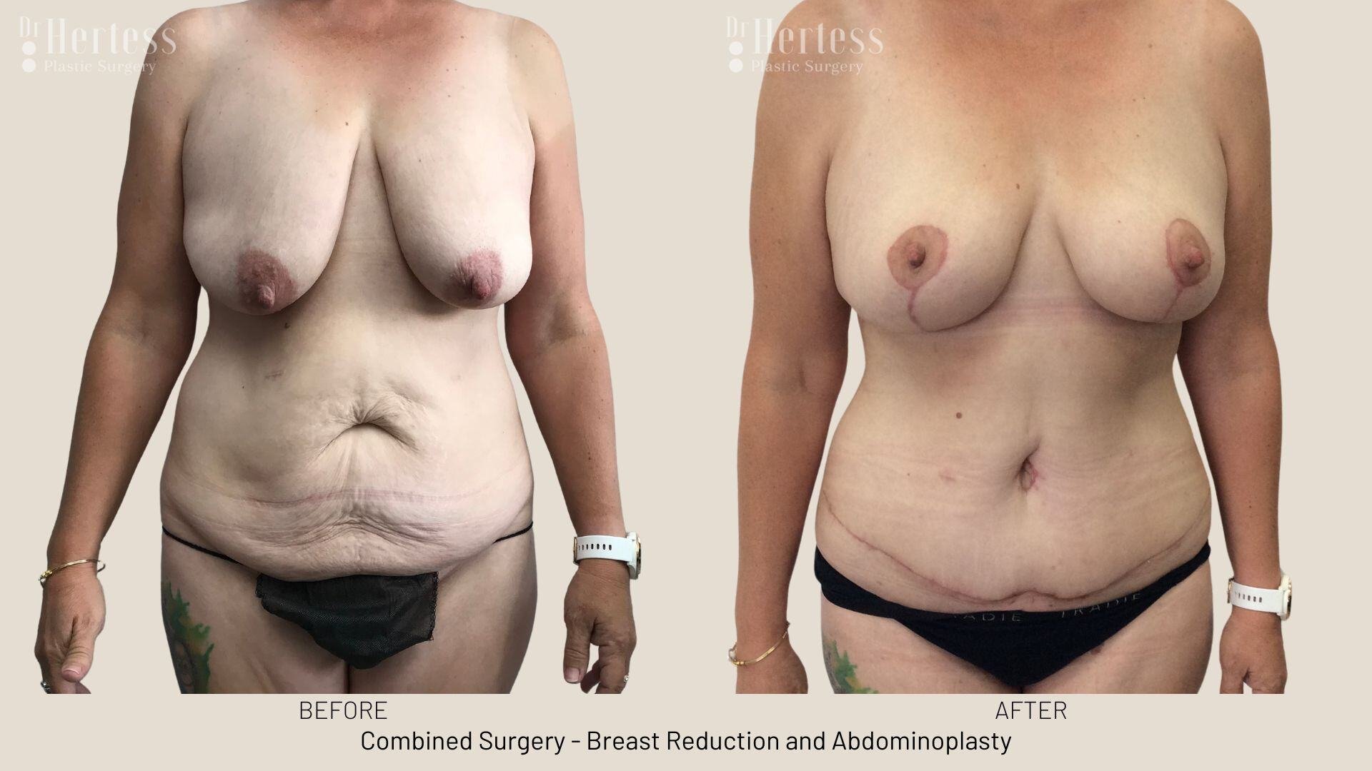 mummy makeover before and after