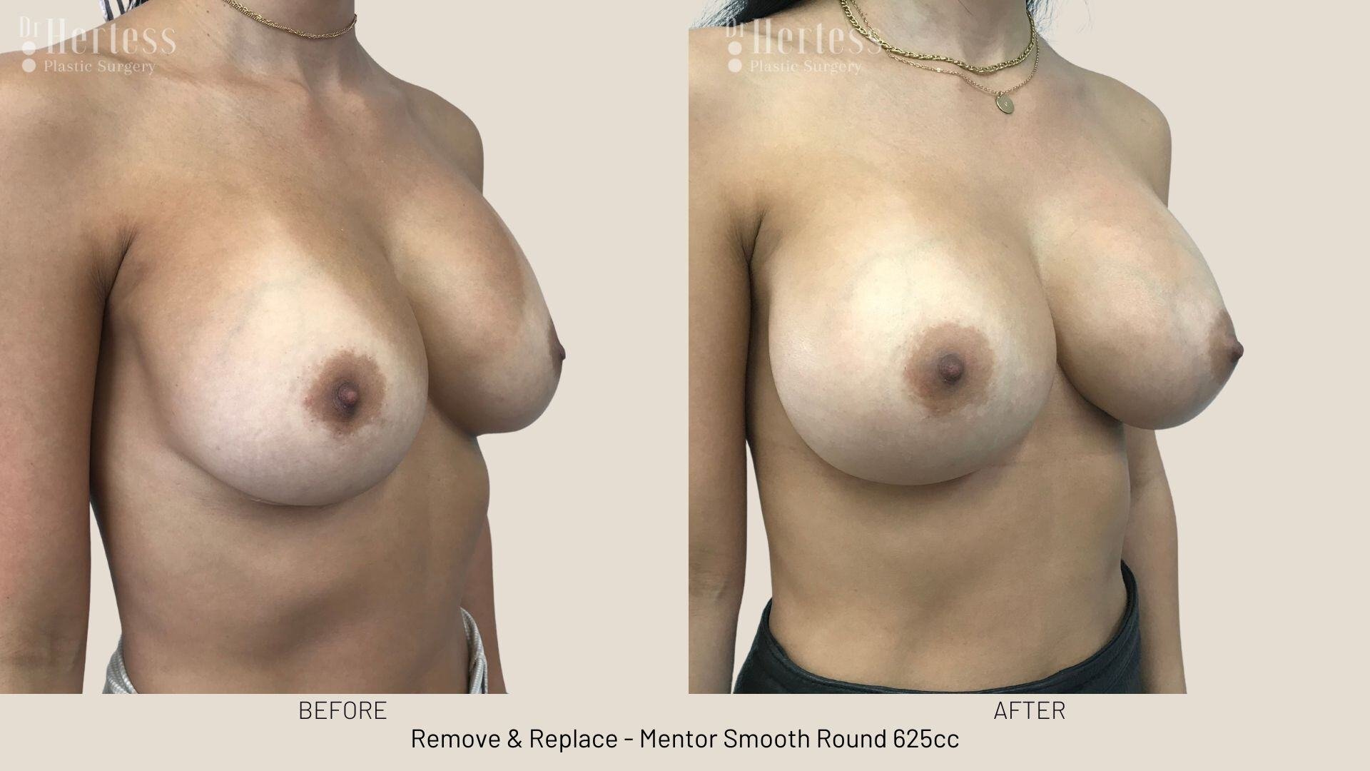 remove replace implants photos