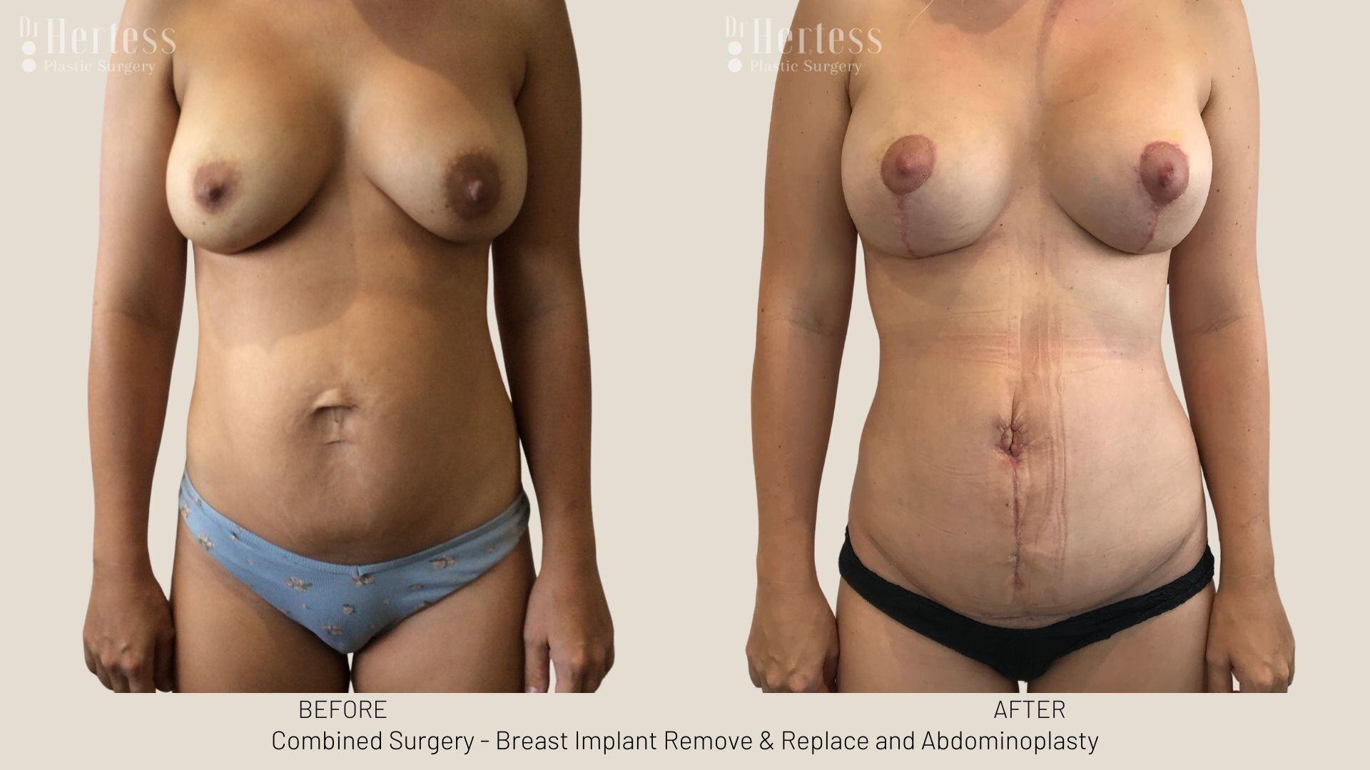 mummy makeover before and after