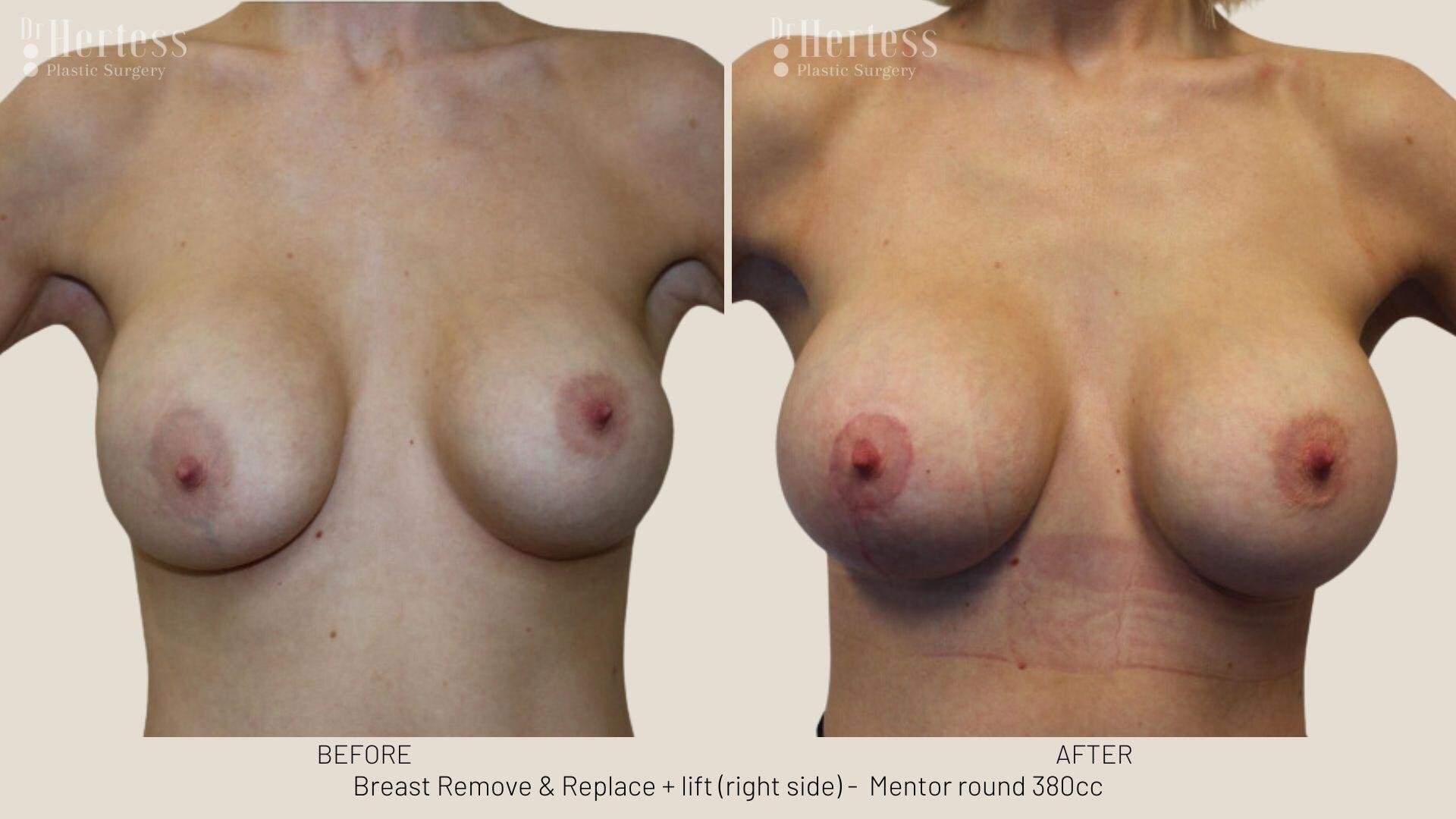 remove replace lift photos