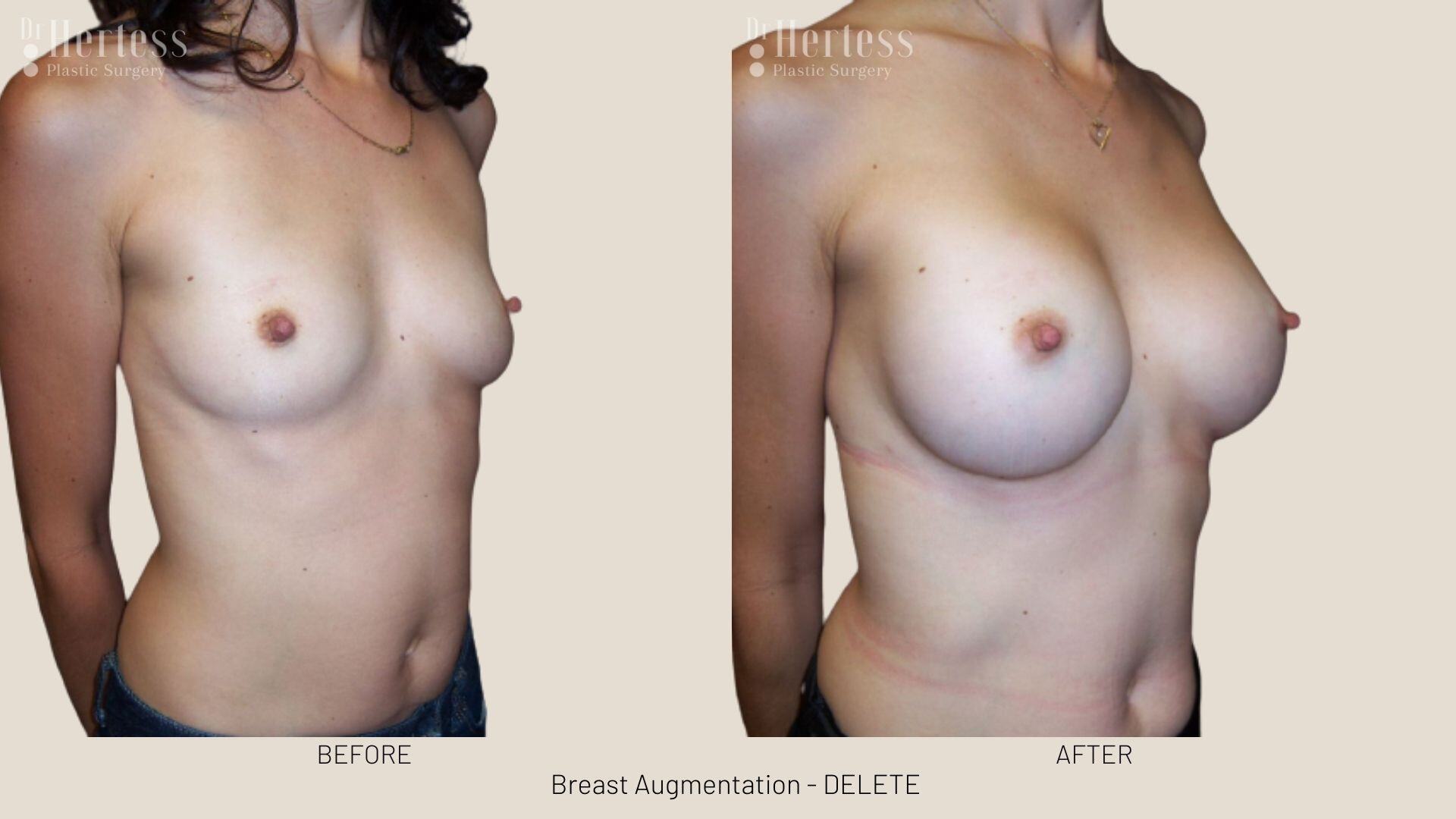 boob job photos before and after