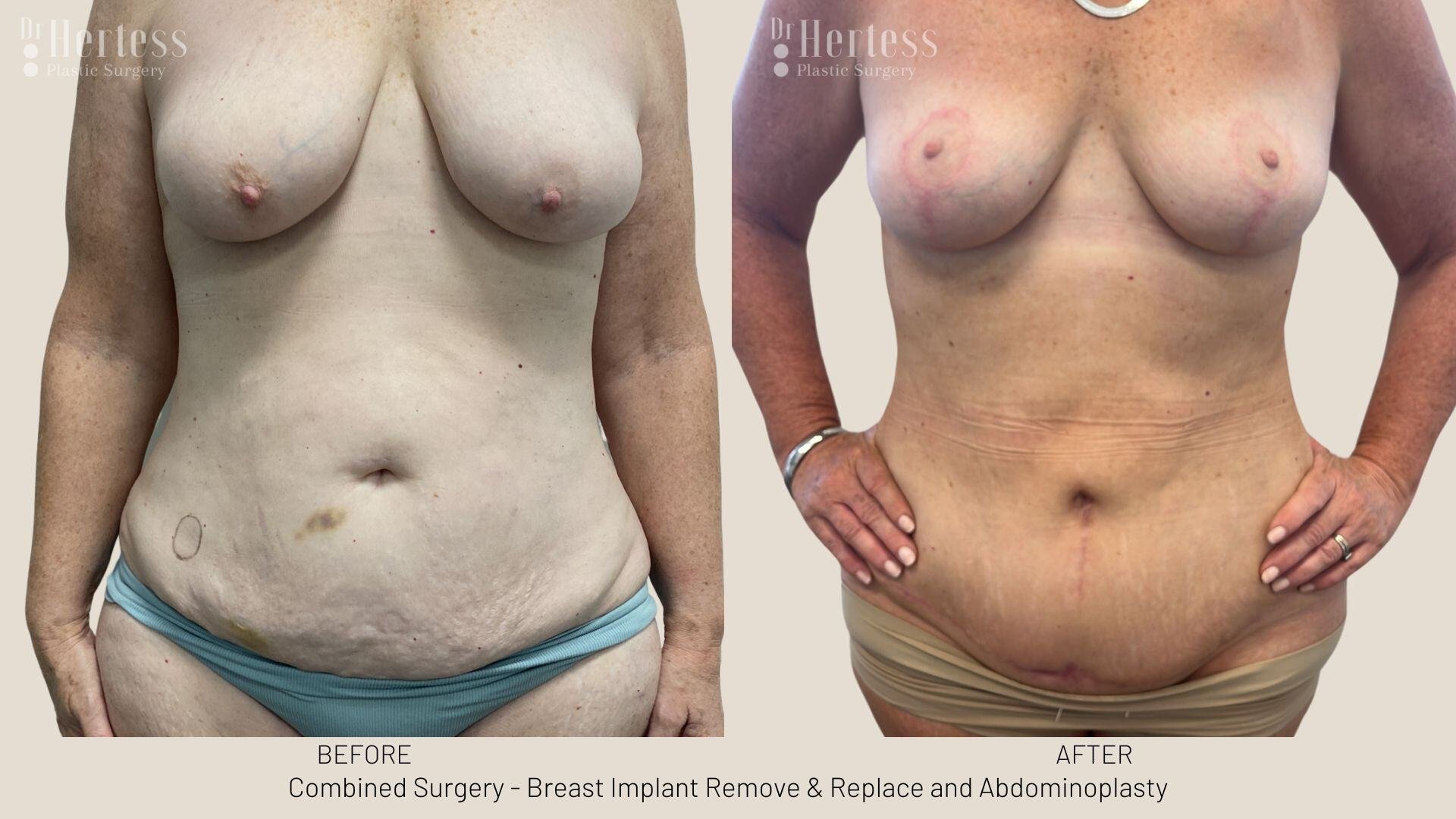 mummy makeover before and after