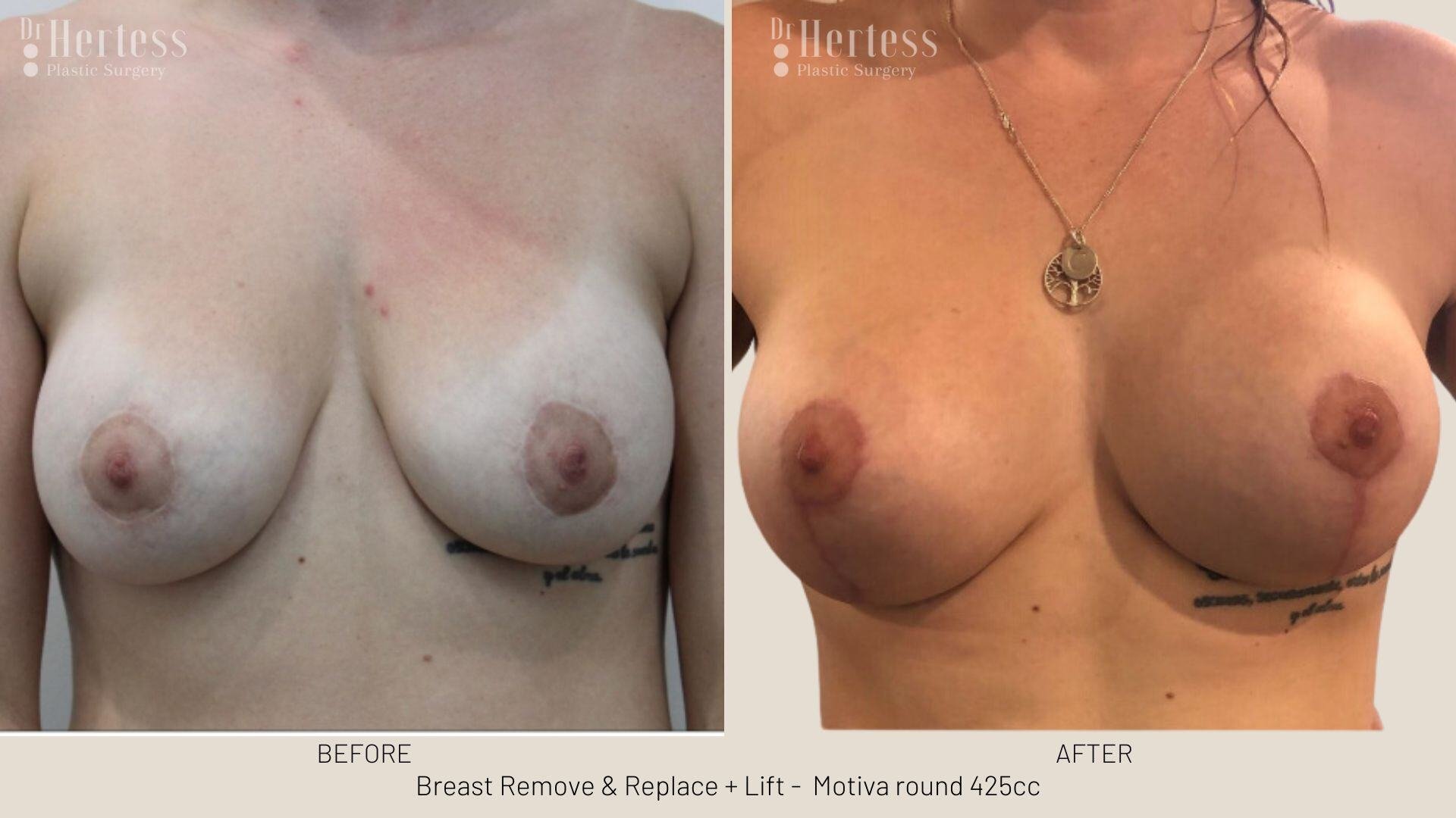 remove replace lift photos
