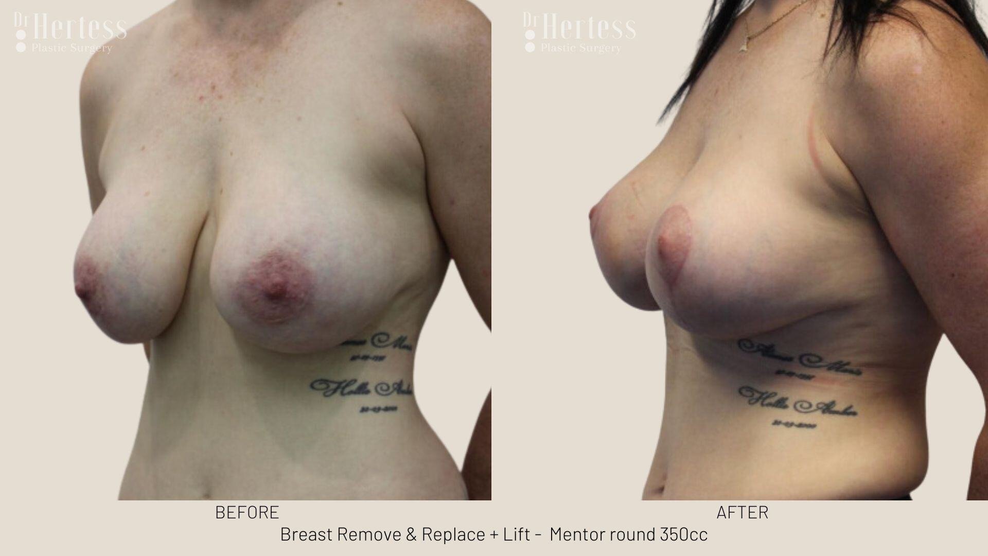 remove replace lift photos