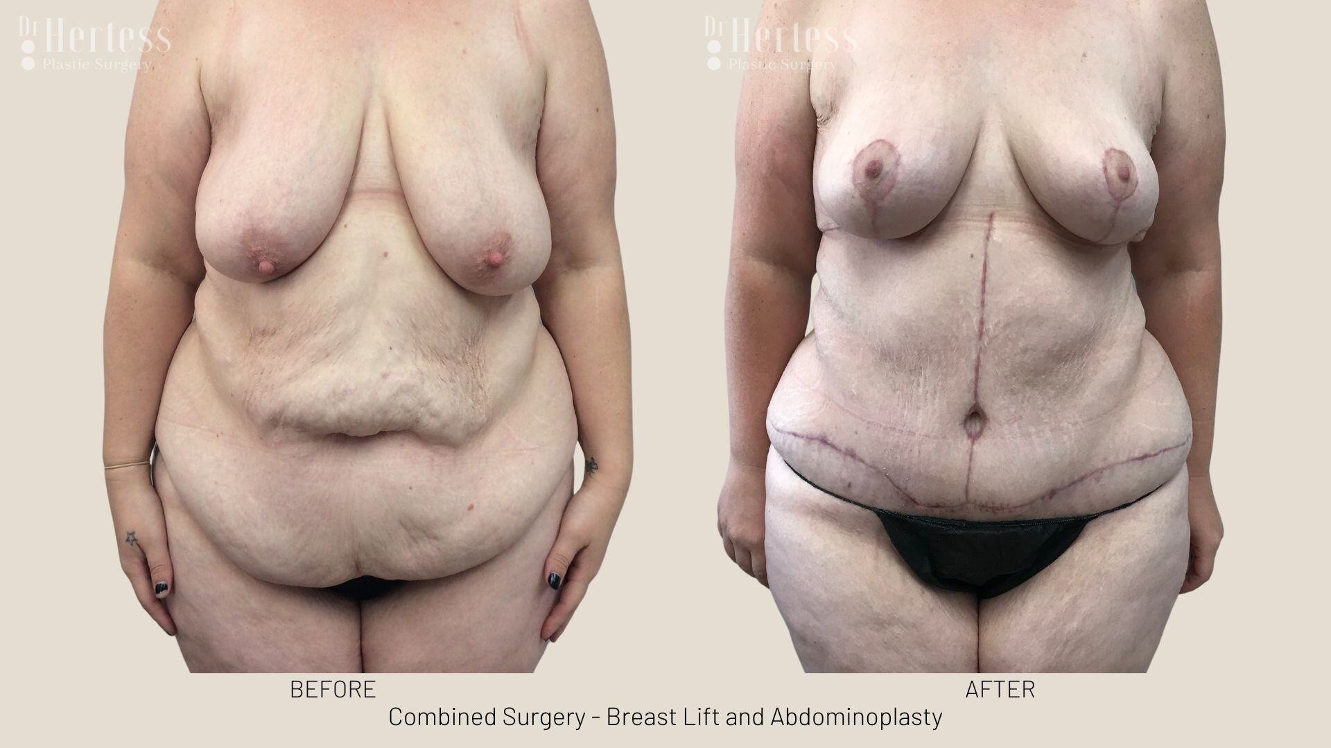 mummy makeover before and after