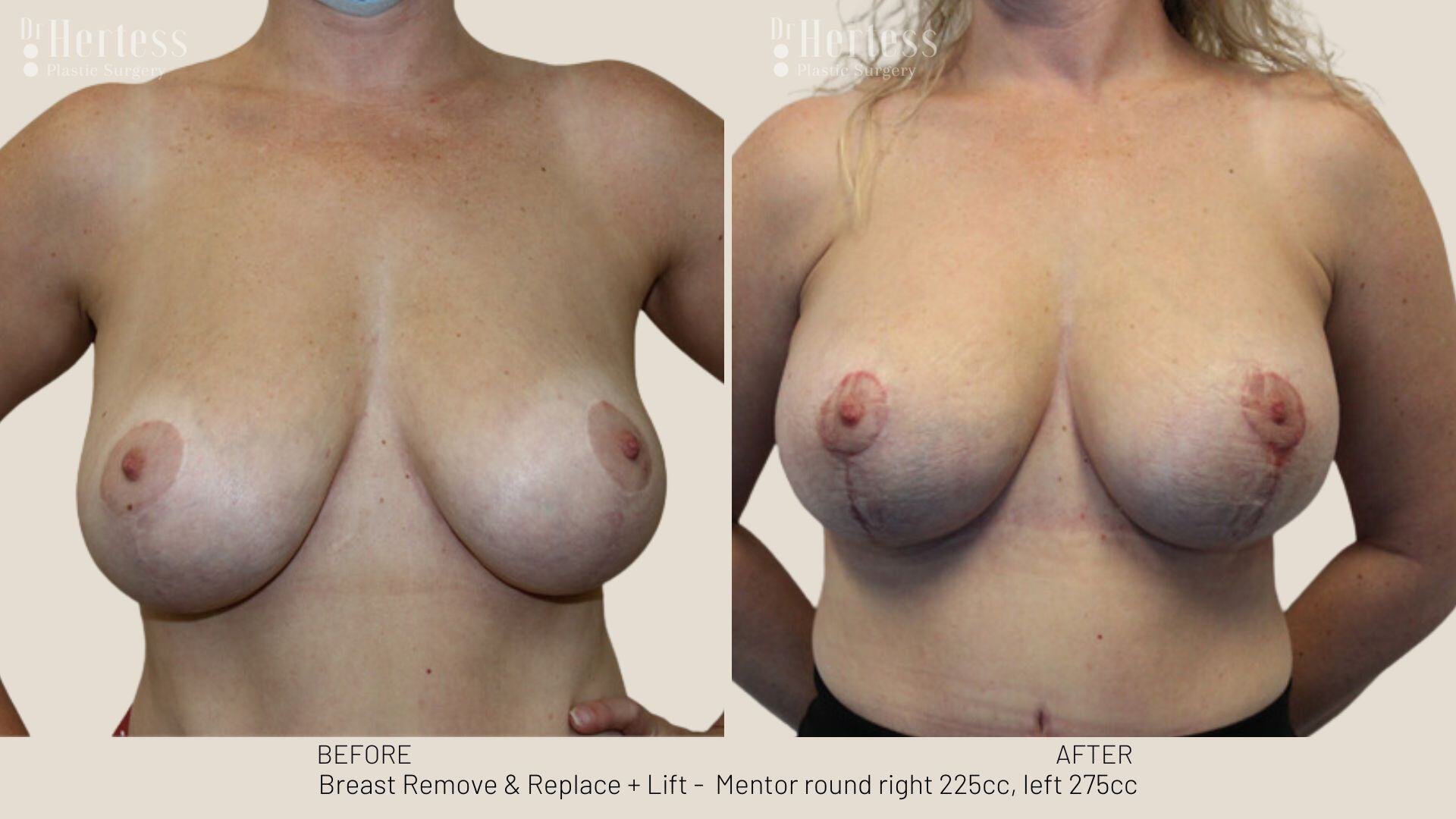 remove replace lift photos