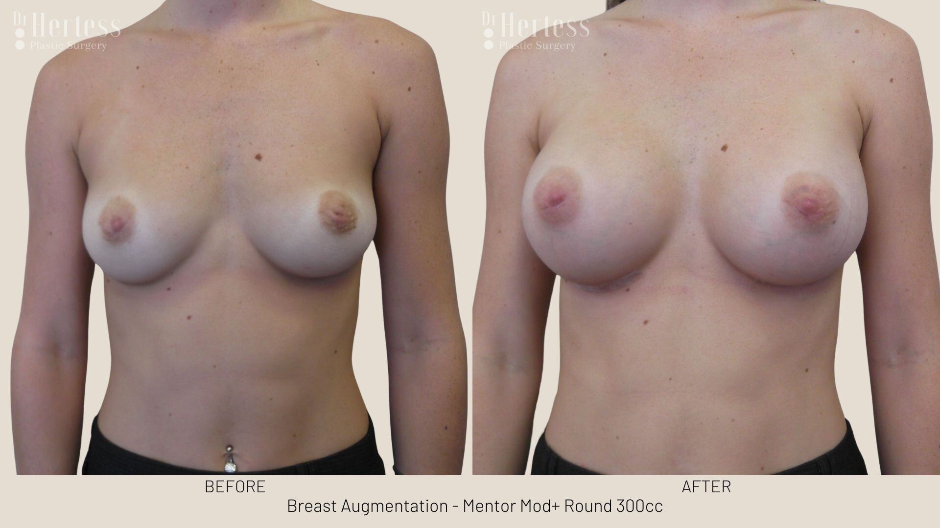 breast implants before and after