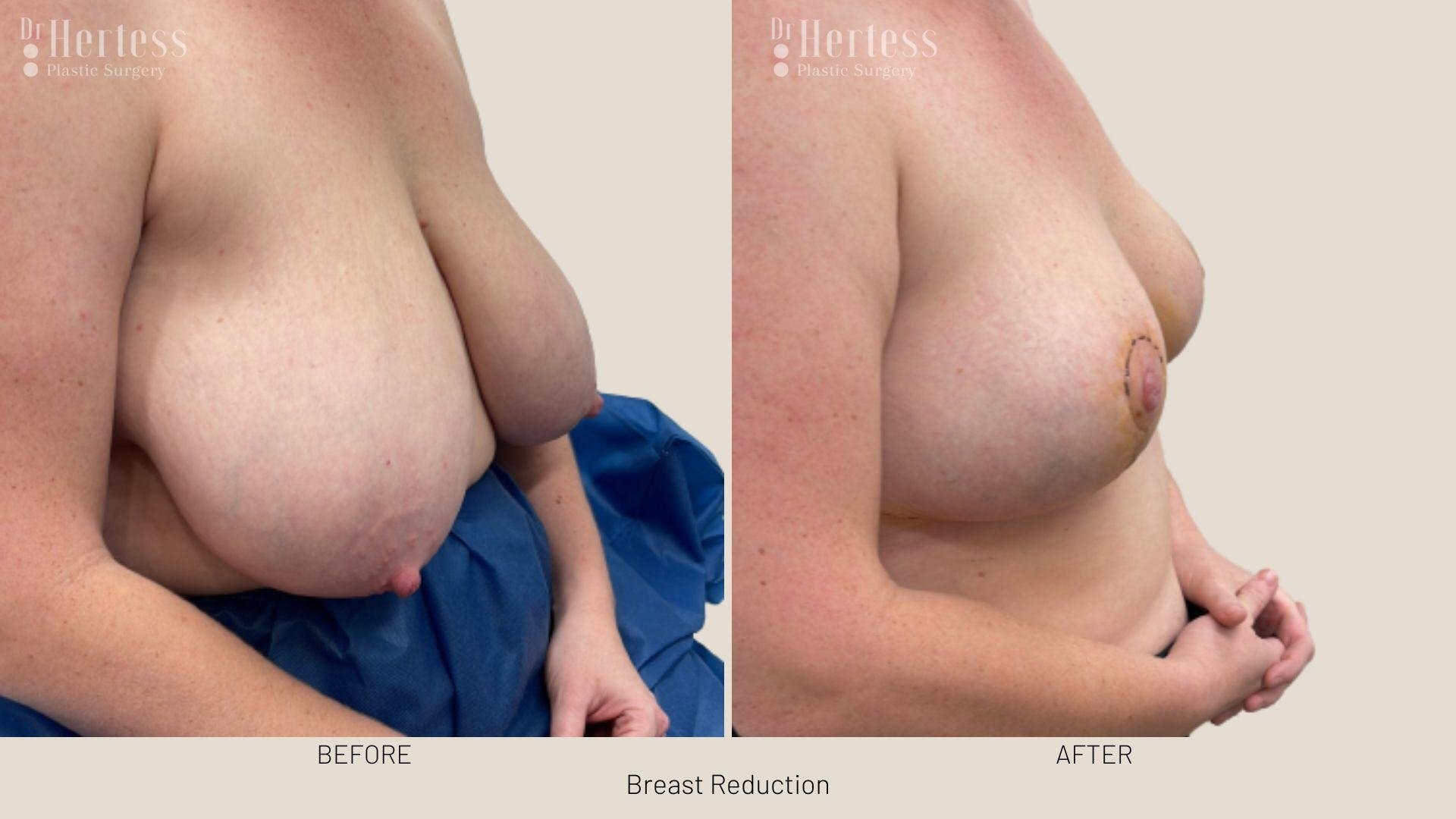 breast reduction before and after