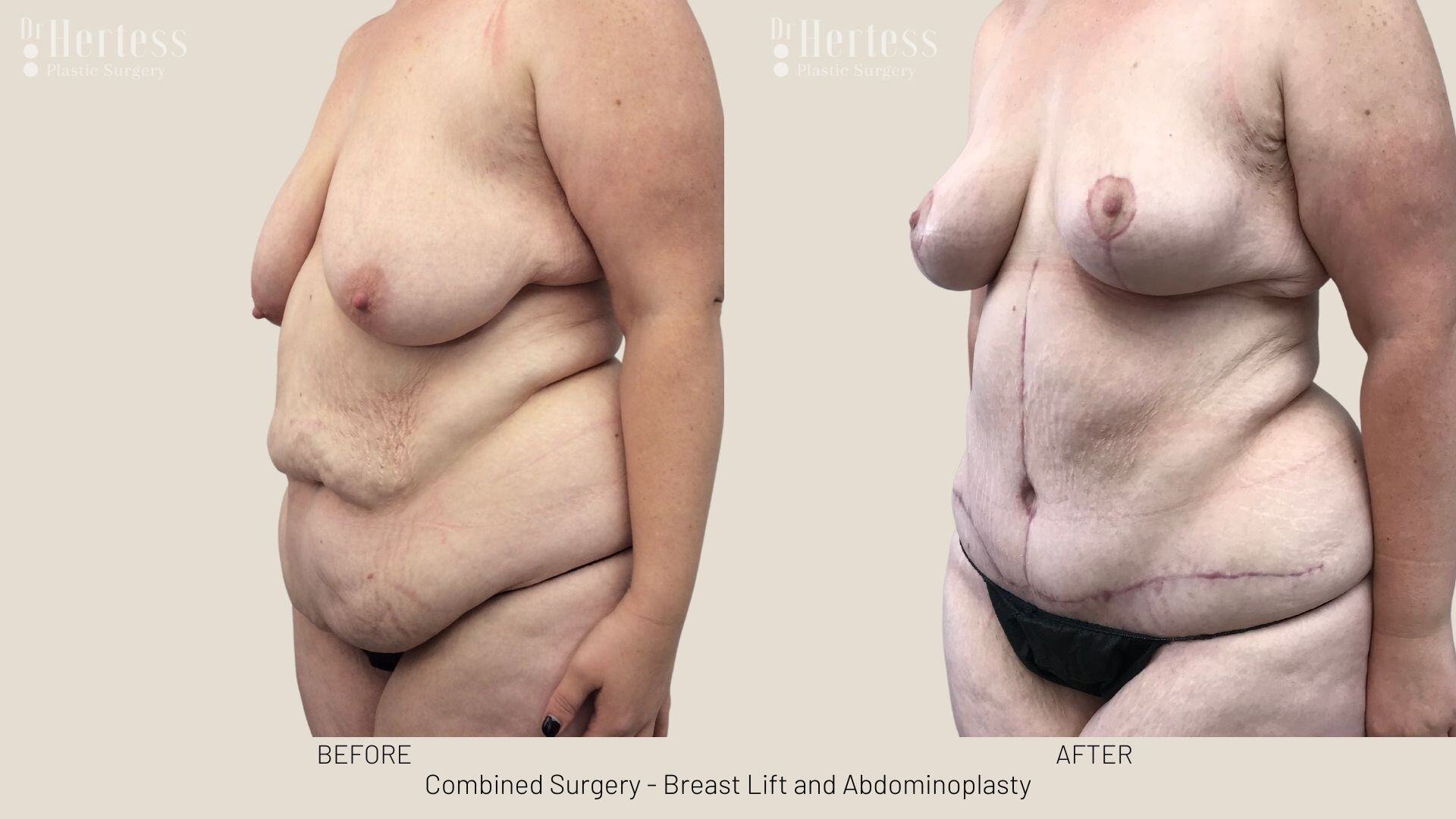 mummy makeover before and after