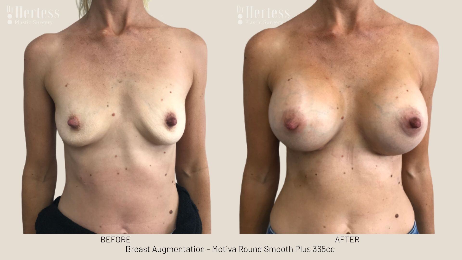 boob job photos before and after