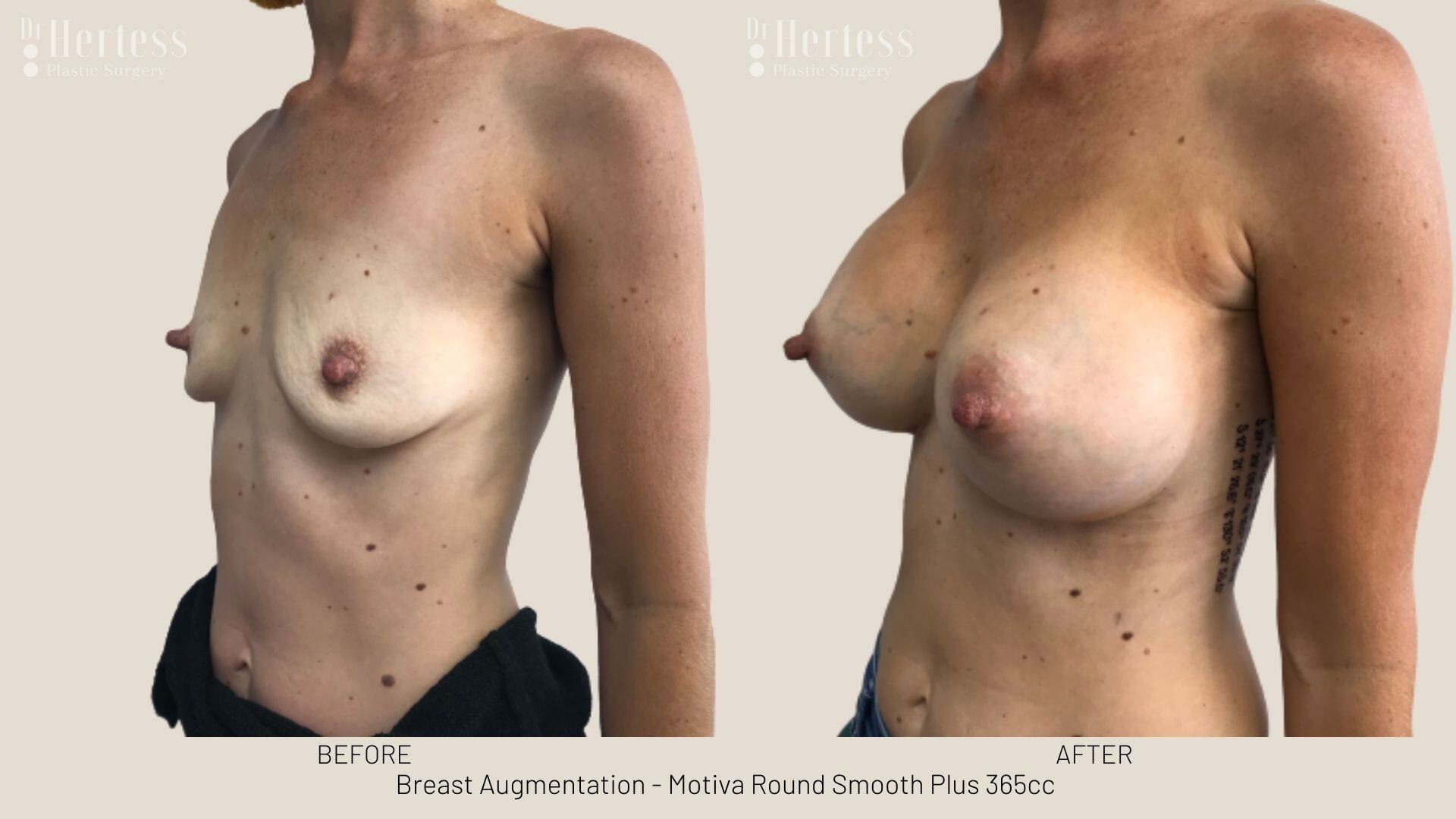 boob job photos before and after