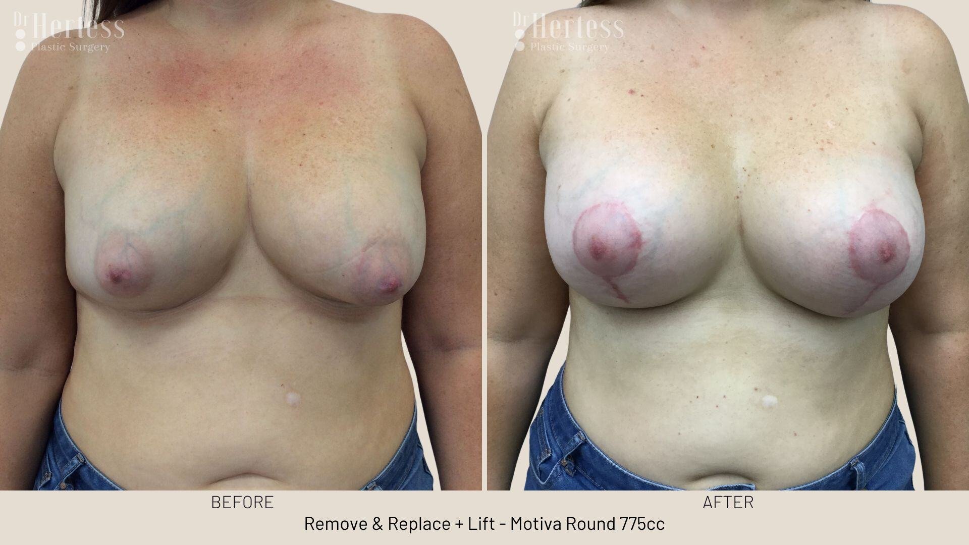 remove replace lift photos