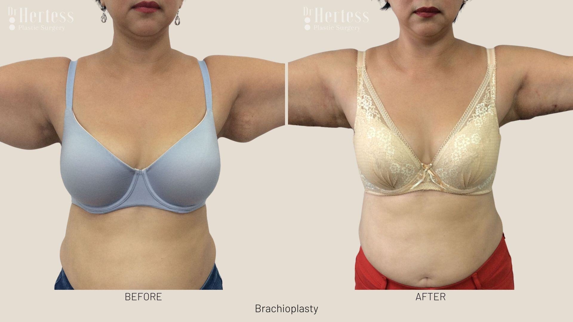 brachioplasty before and after photos