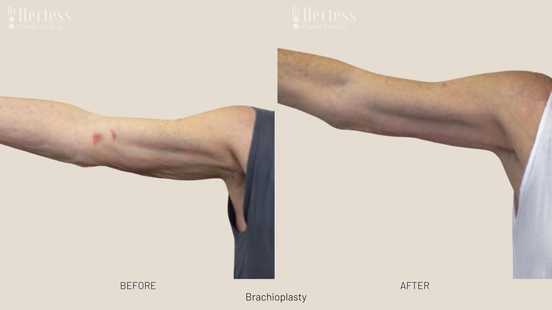 brachioplasty before and after photos