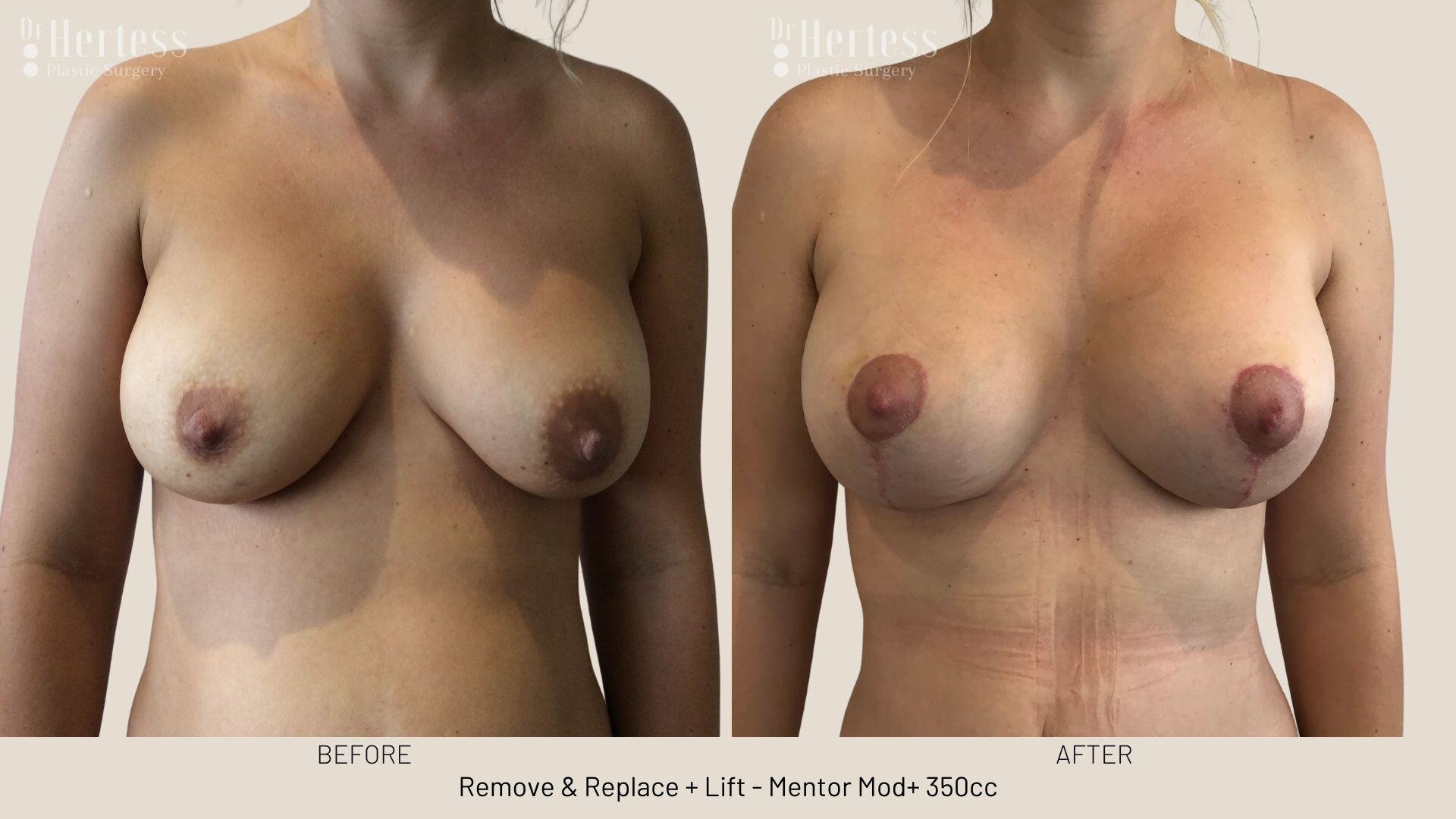 remove replace lift photos