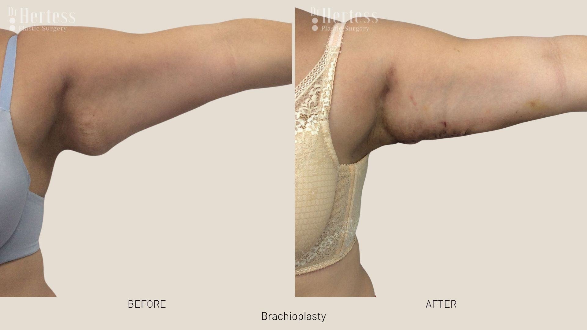 brachioplasty before and after photos