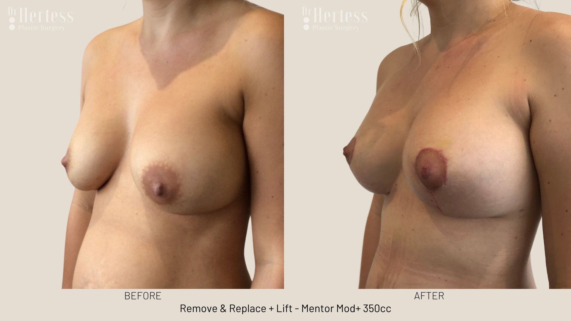 remove replace lift photos
