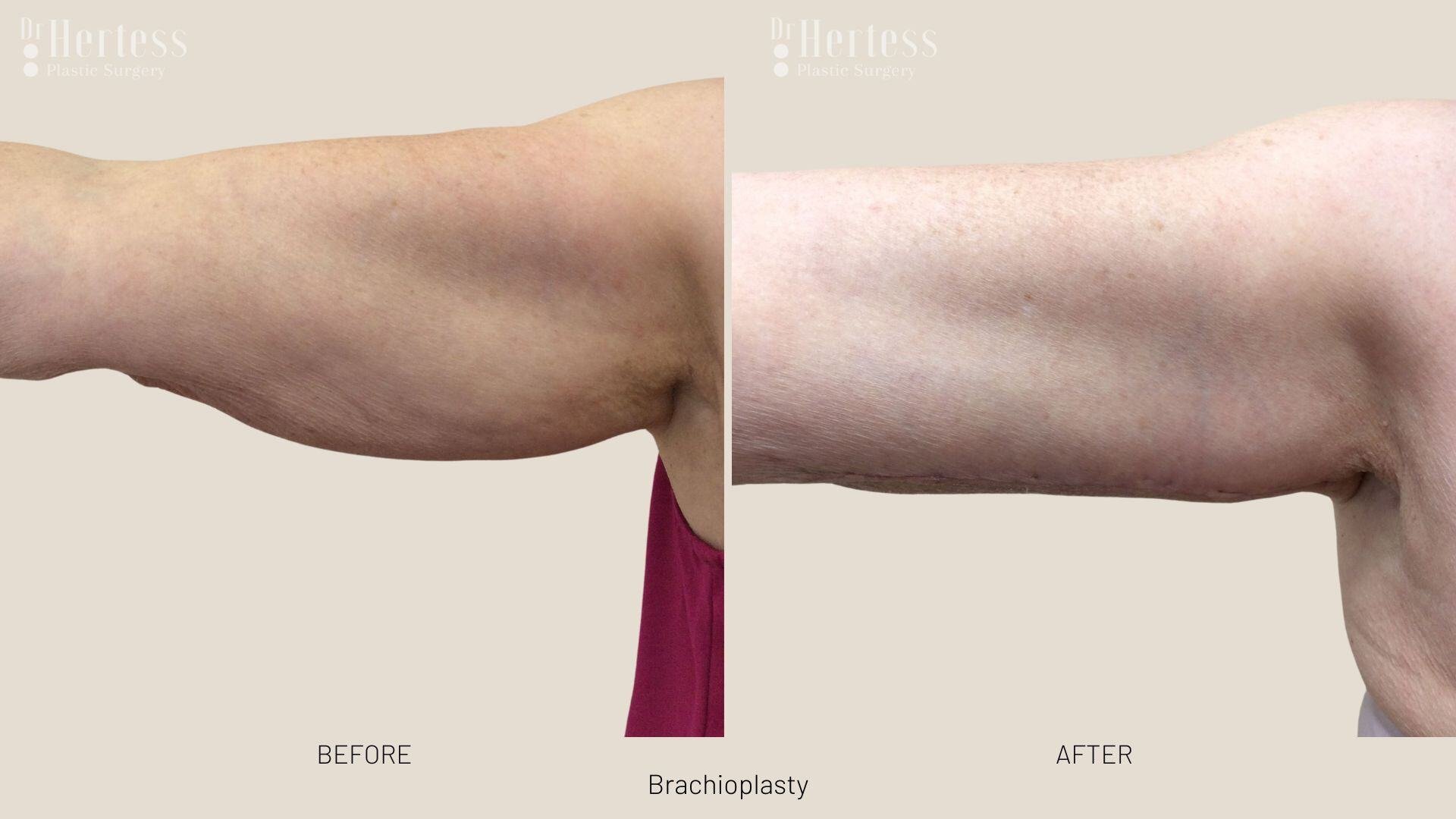 brachioplasty before and after photos