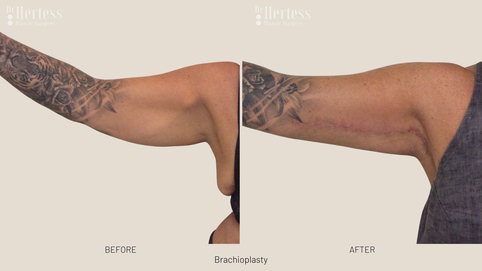 brachioplasty before and after photos