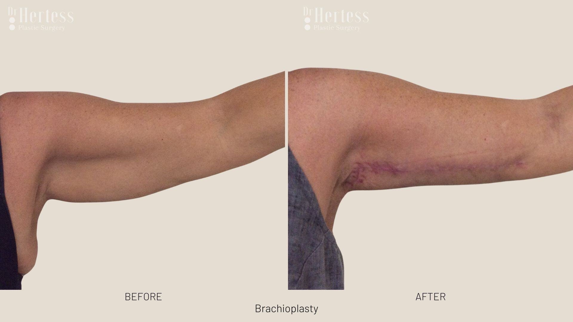brachioplasty before and after photos